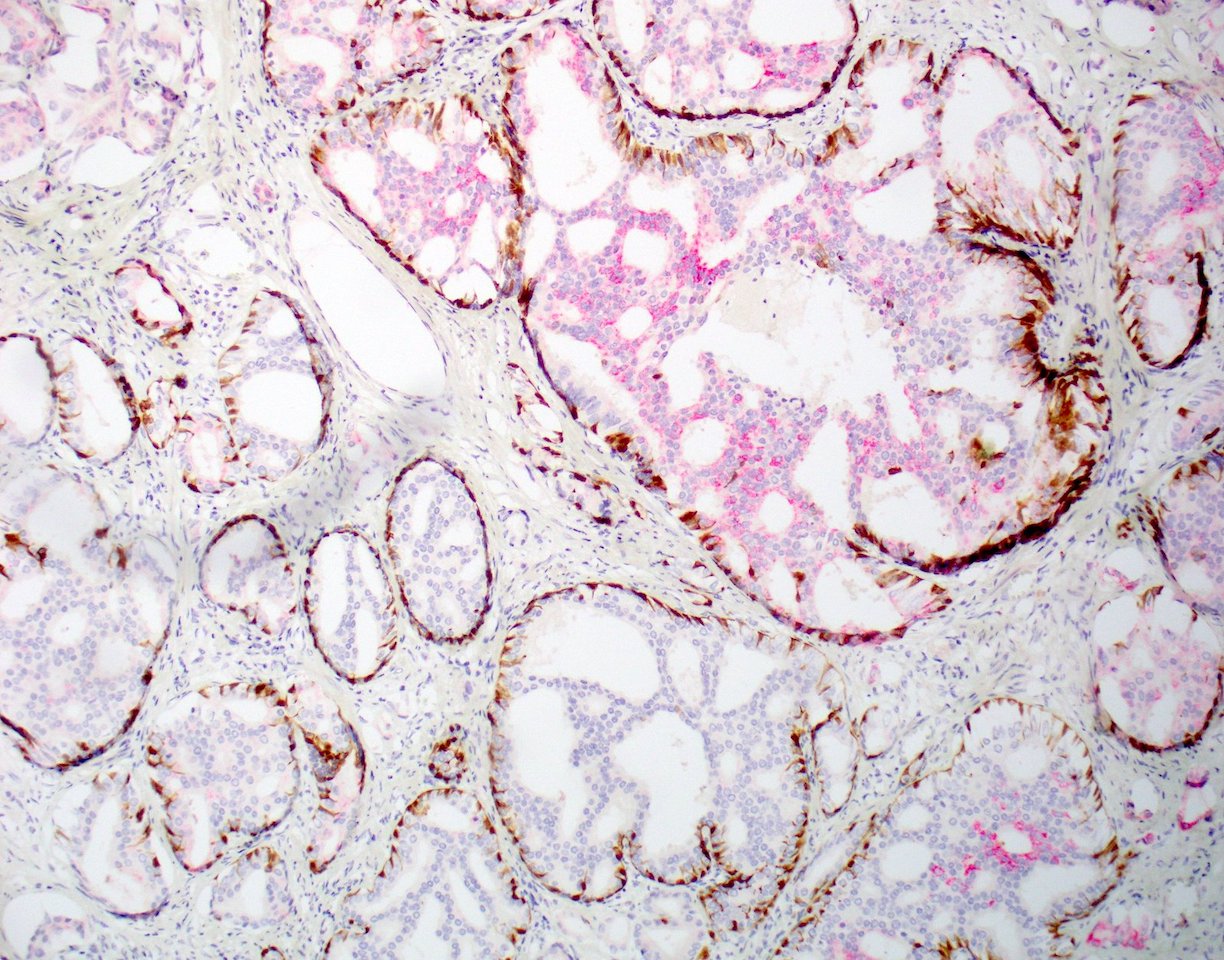 prostate cancer pathology outlines immunohistochemistry Fibrózis a prosztata vizeletben