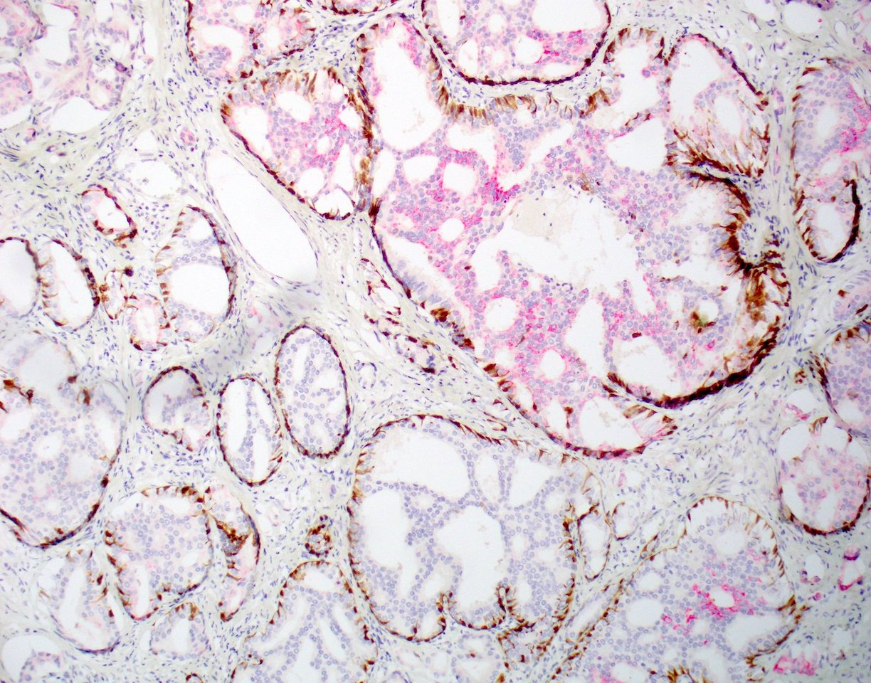 Changes of protein expression in prostate cancer having lost its androgen sensitivity.