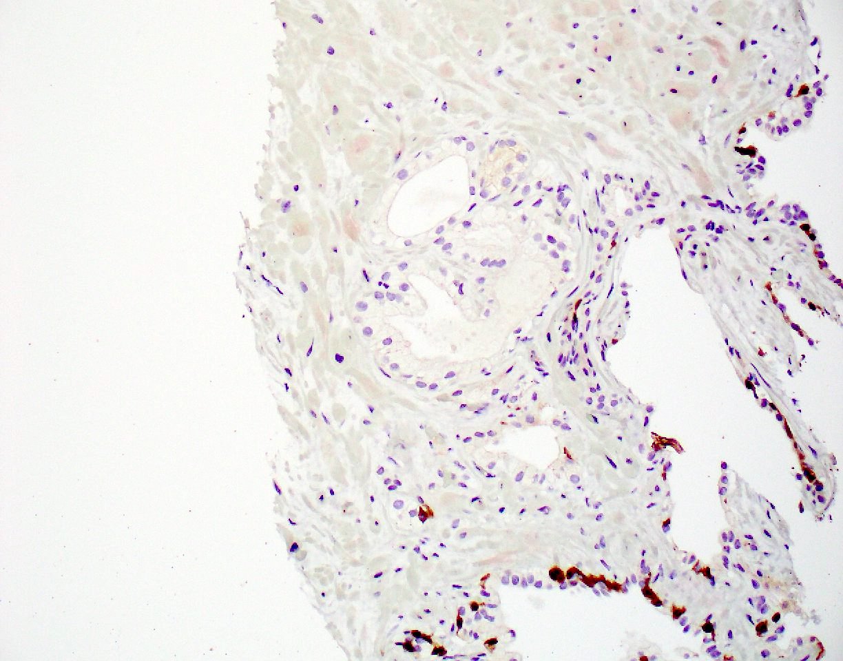 prostate adenocarcinoma ihc pathology outlines