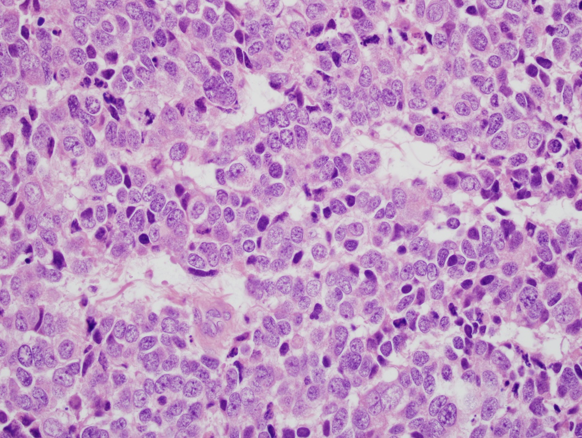adenocarcinoma with neuroendocrine differentiation pathology outlines krónikus prosztatitis gyertyák kezelése