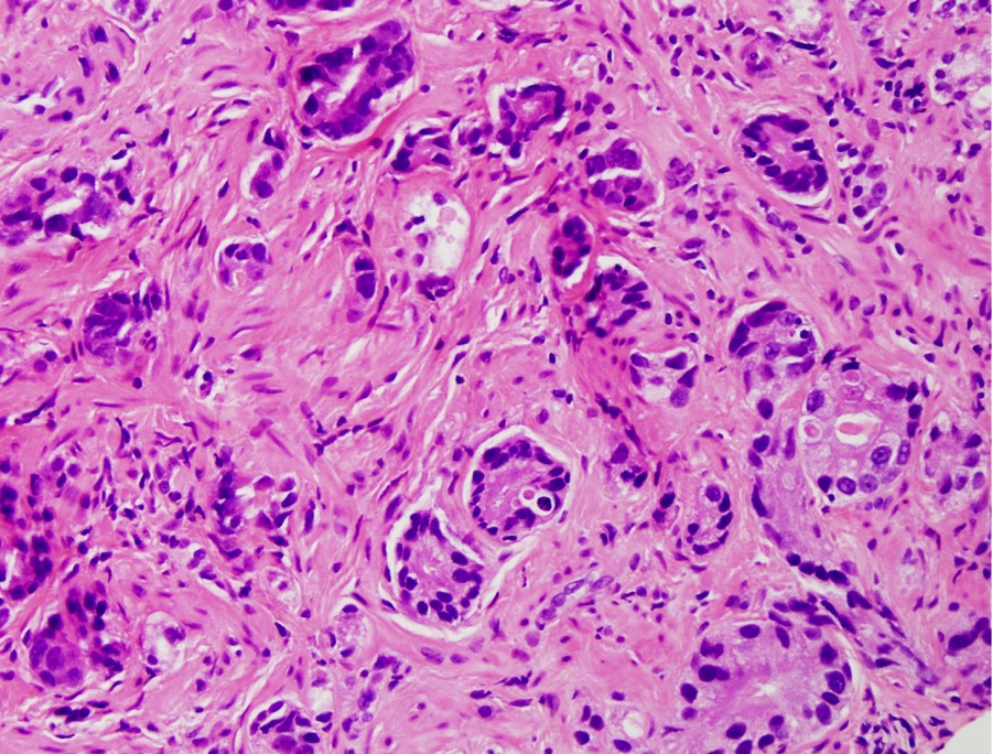 prostate neuroendocrine carcinoma pathology outlines