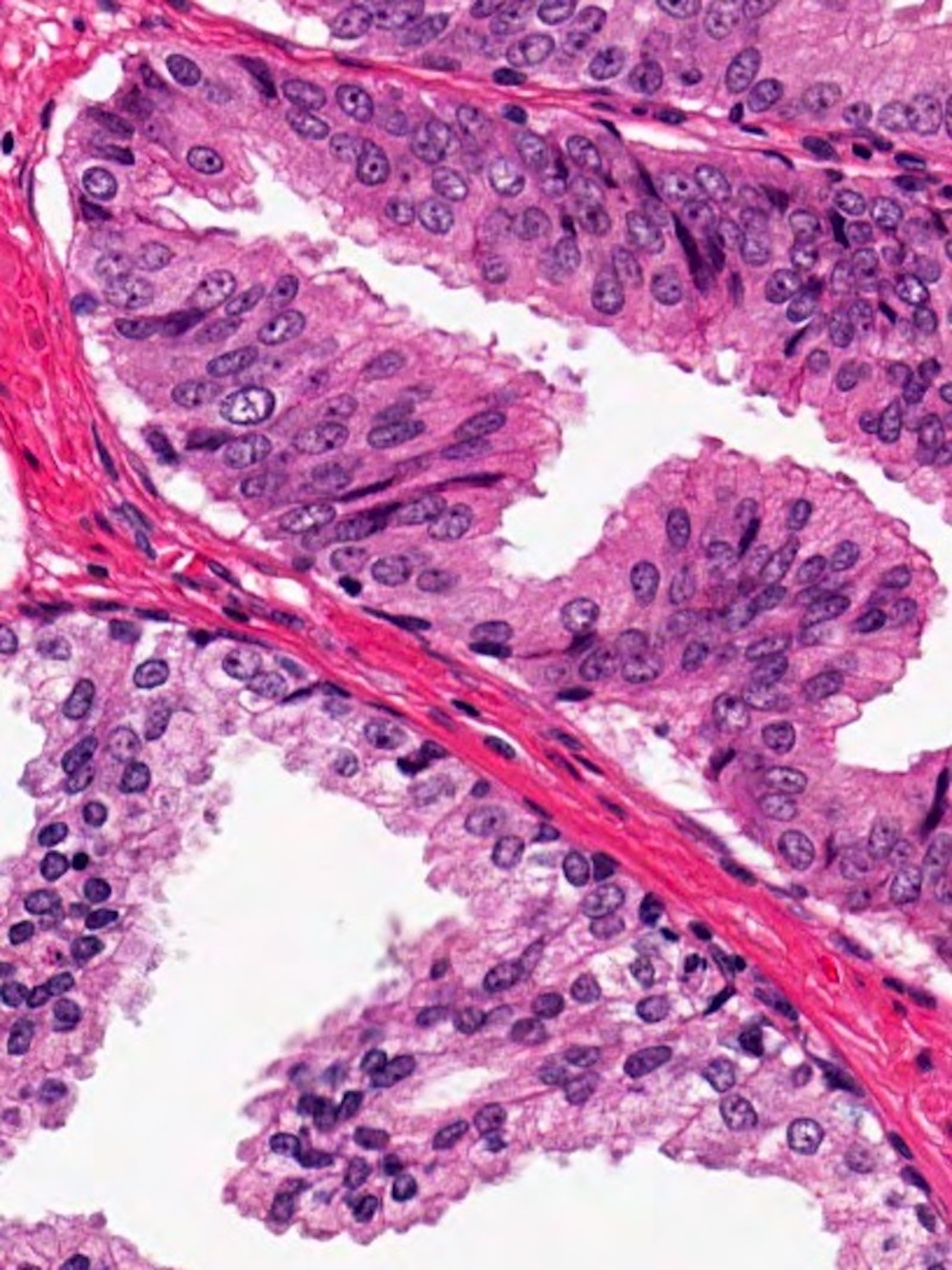 pin prostate pathology outlines Petrezselyem tinktúra prosztatitis