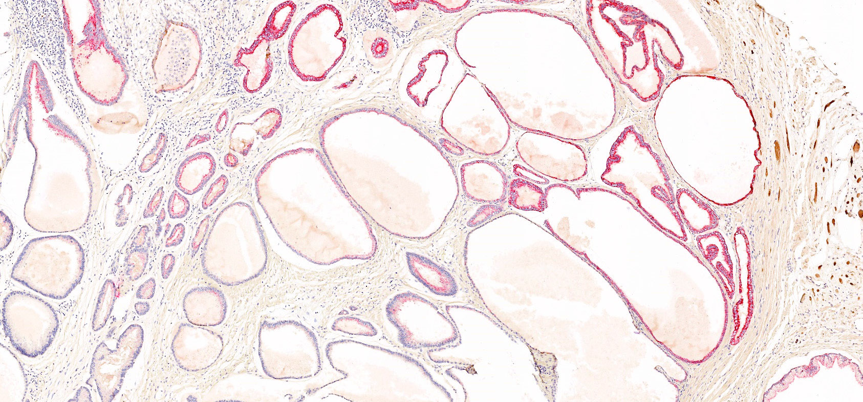 Cytoplasmic P504S
