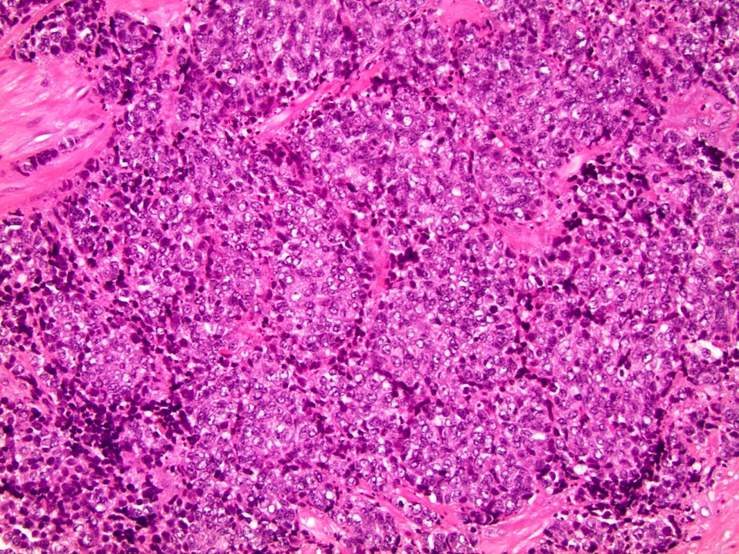Prostate neuroendocrine carcinoma pathology outlines