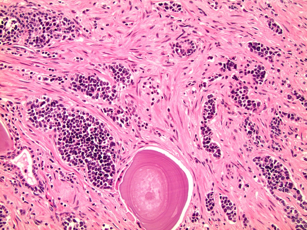 Prostate adenocarcinoma pathology outlines. Colorectal cancer histology, Cancer colon pathology
