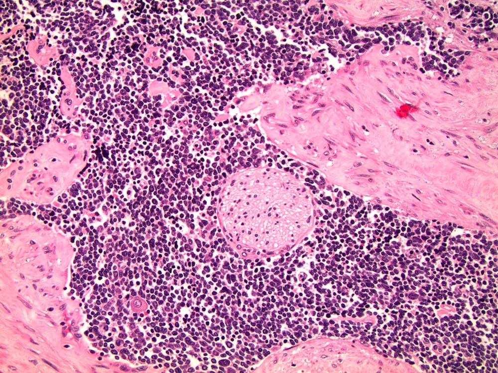 adenocarcinoma with neuroendocrine differentiation pathology outlines chronic bacterial prostatitis reddit