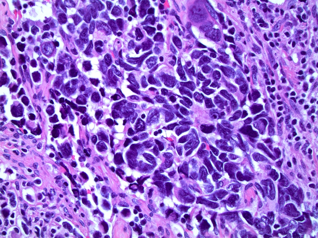 adenocarcinoma with neuroendocrine differentiation pathology outlines dimensioni prostata a 60 anni