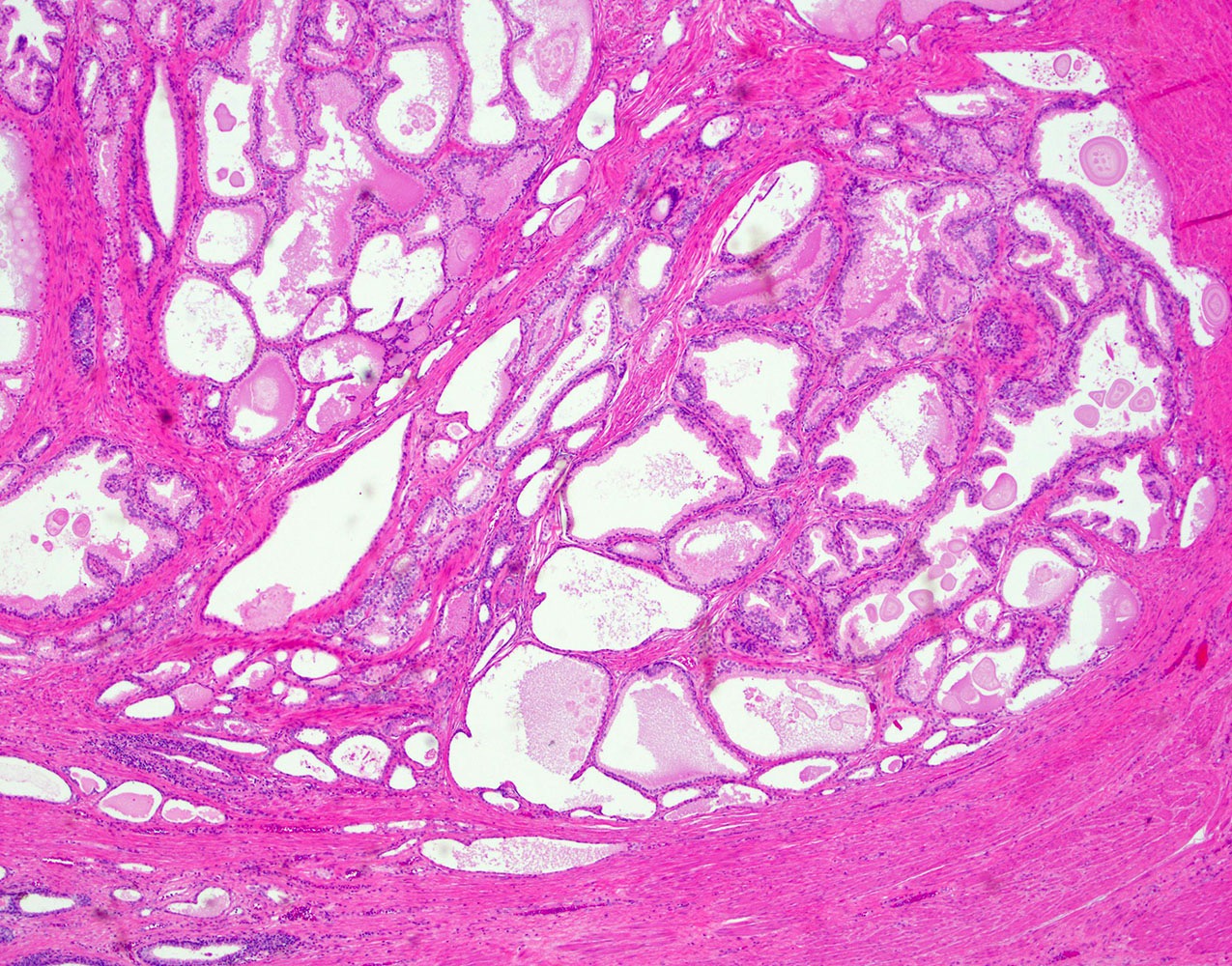Papillary urothelial hyperplasia pathology outlines, Papillary urothelial hyperplasia bladder,