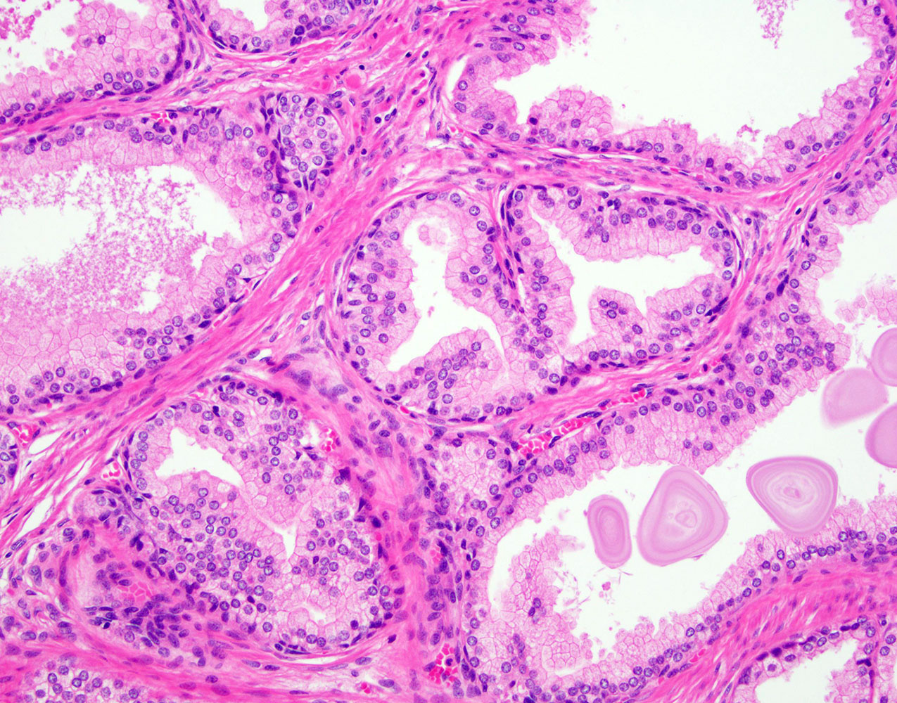 basal cell hyperplasia prostate pathology outlines