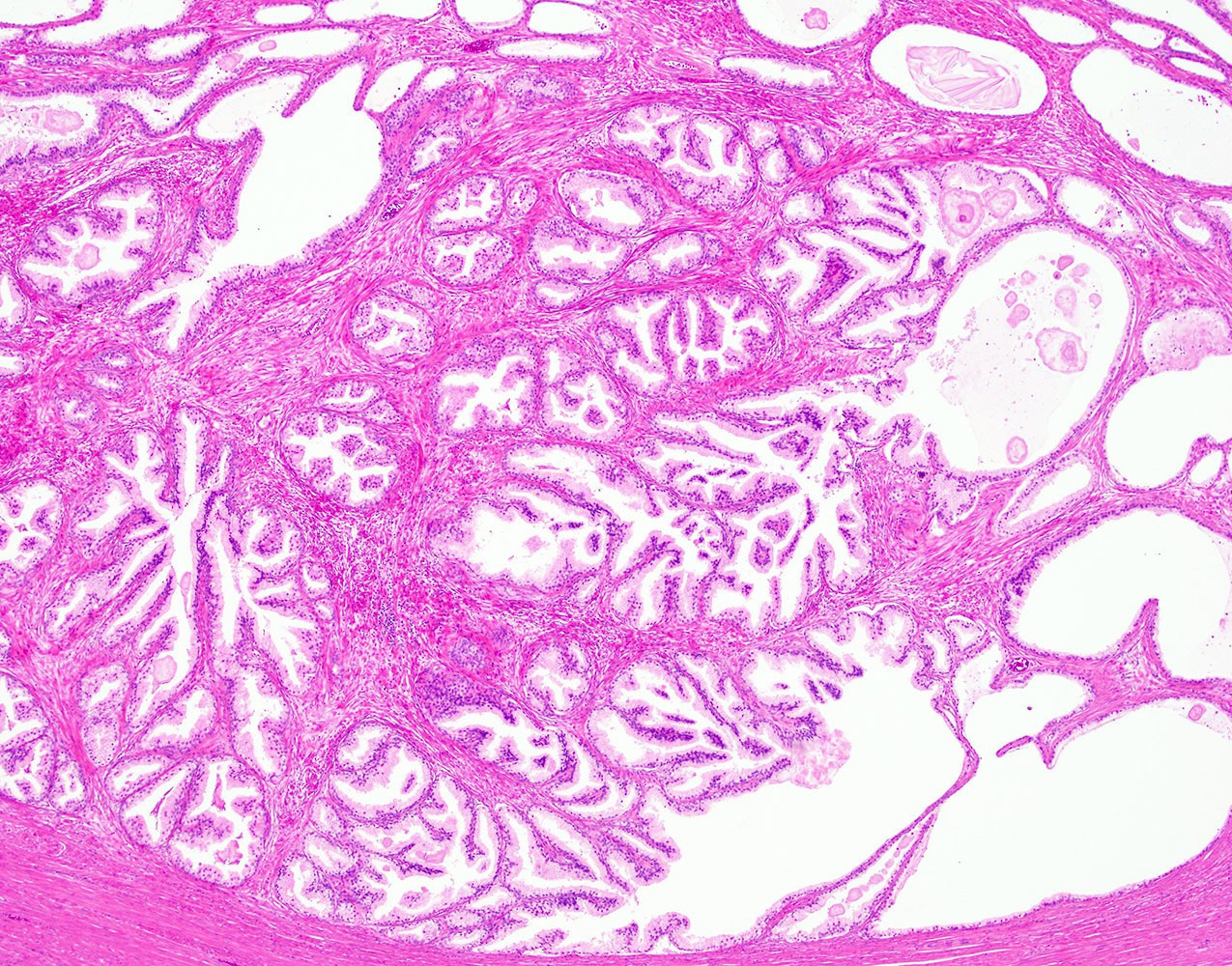 Papillary urothelial hyperplasia pathology. Papillary urothelial hyperplasia pathology