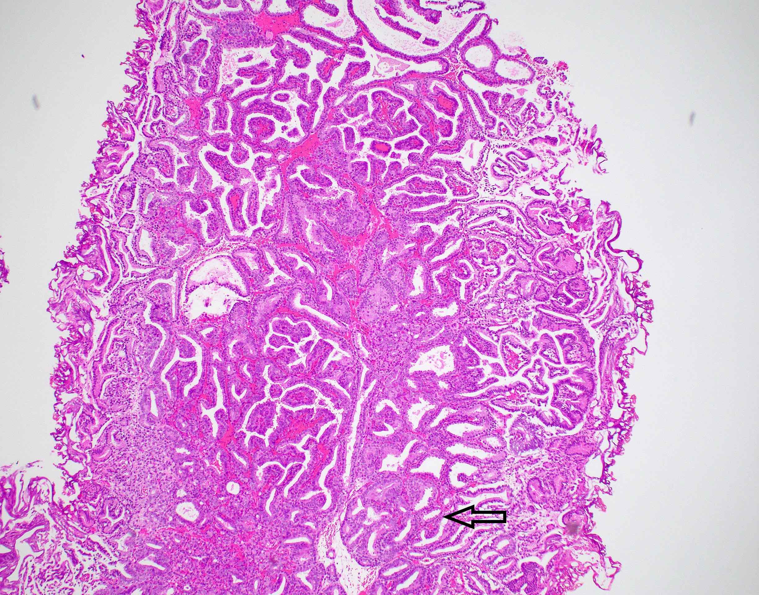 Papillary and cribriform pattern
