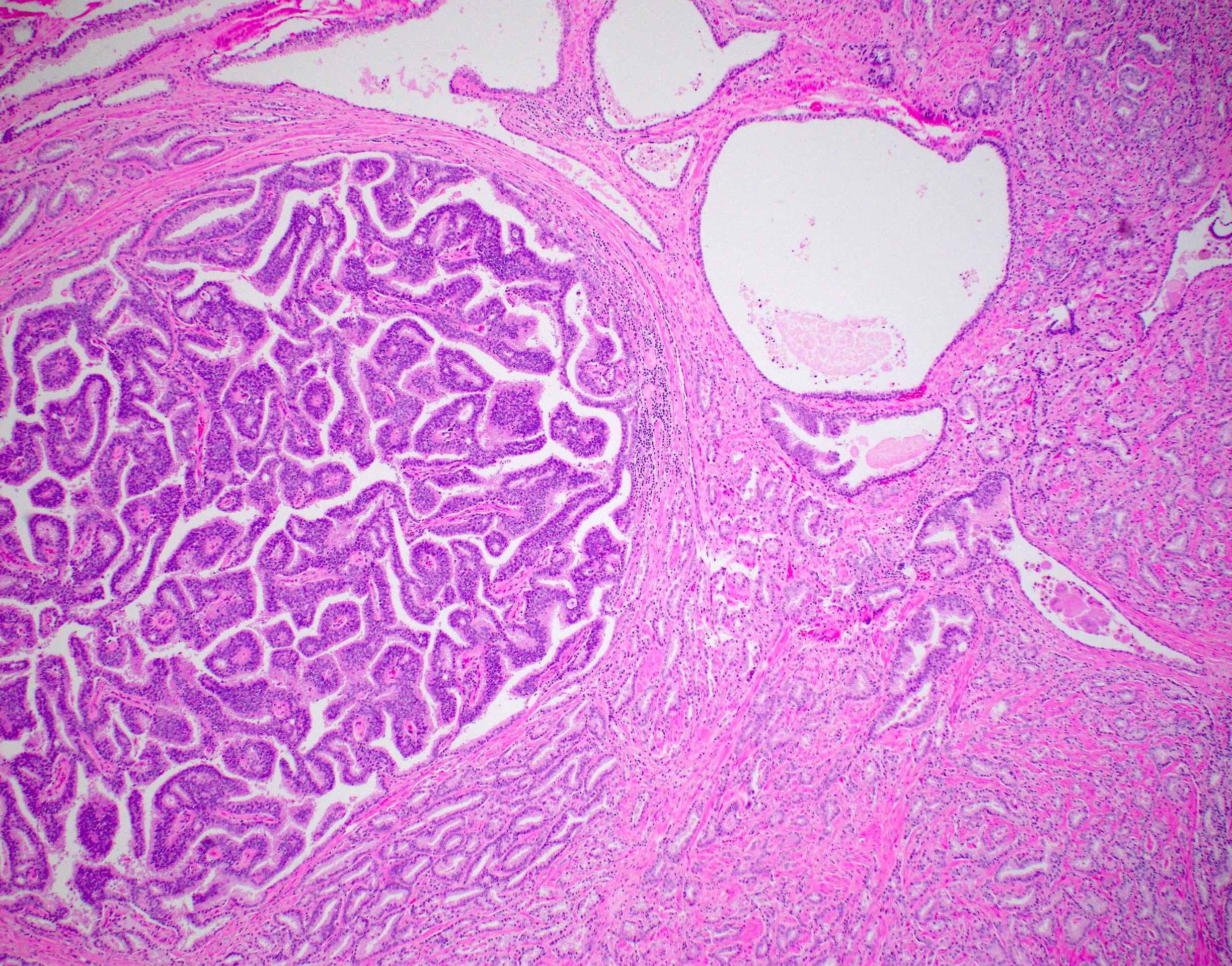 Mixed acinar and ductal adenocarcinoma