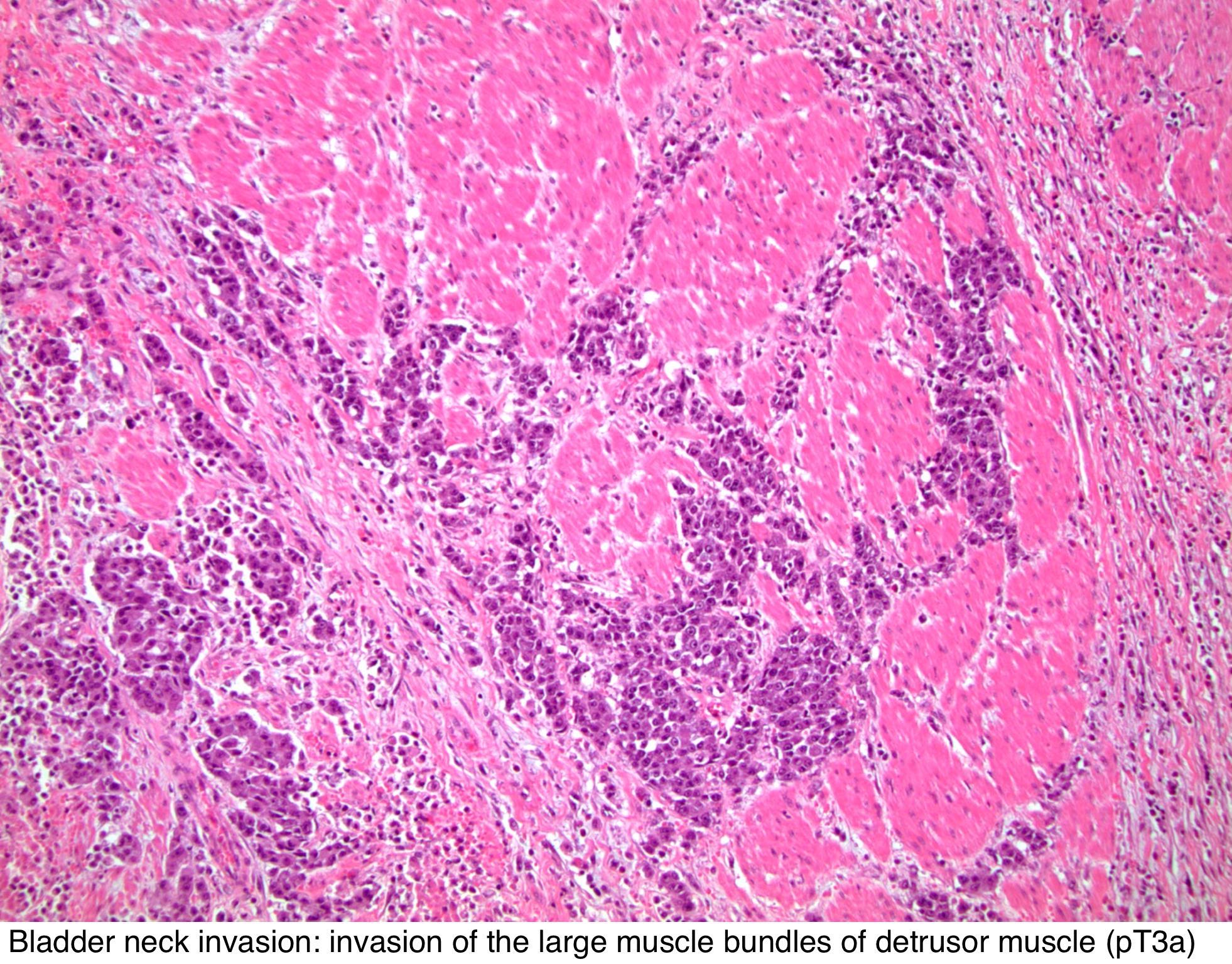 bladder neck involvement prostate cancer