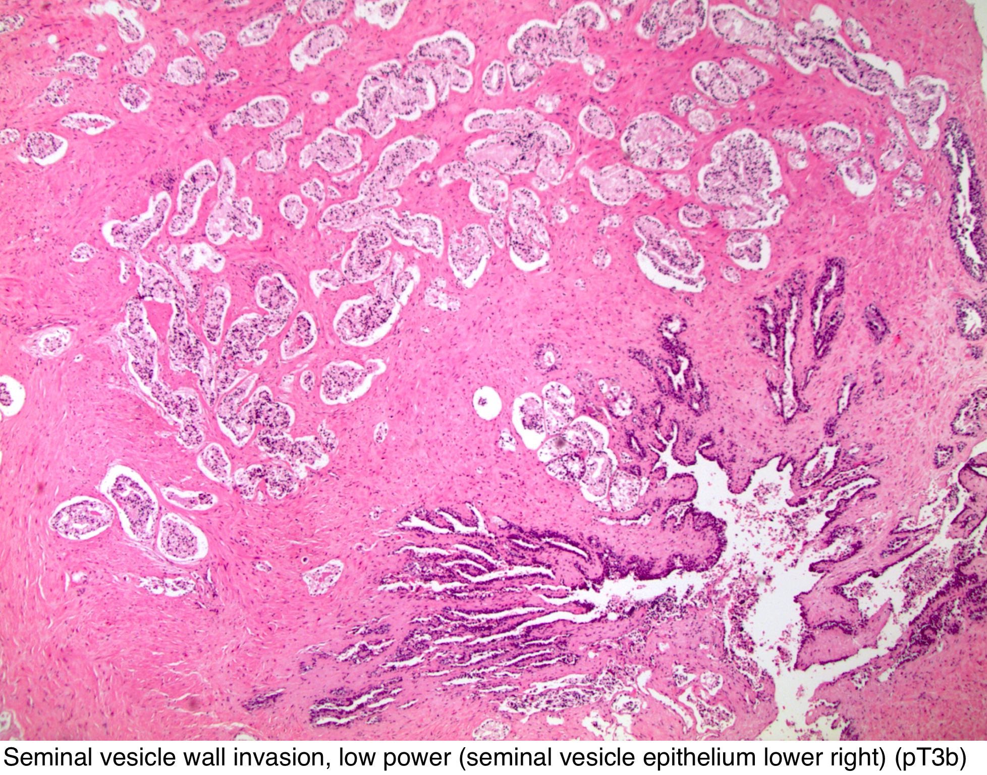 Urothelial carcinoma prostate pathology outlines