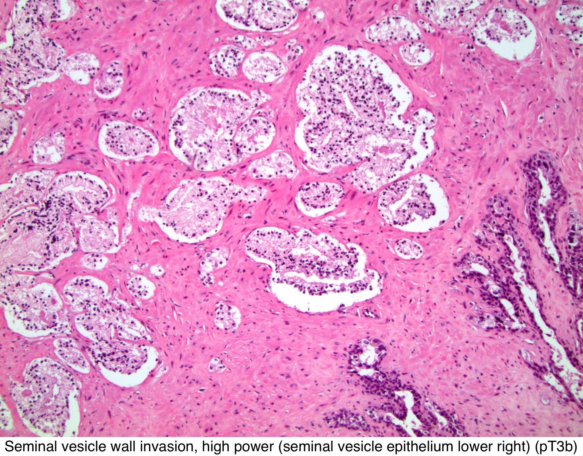 prostate adenocarcinoma tnm pathology outlines cum să scazi cu prostatita
