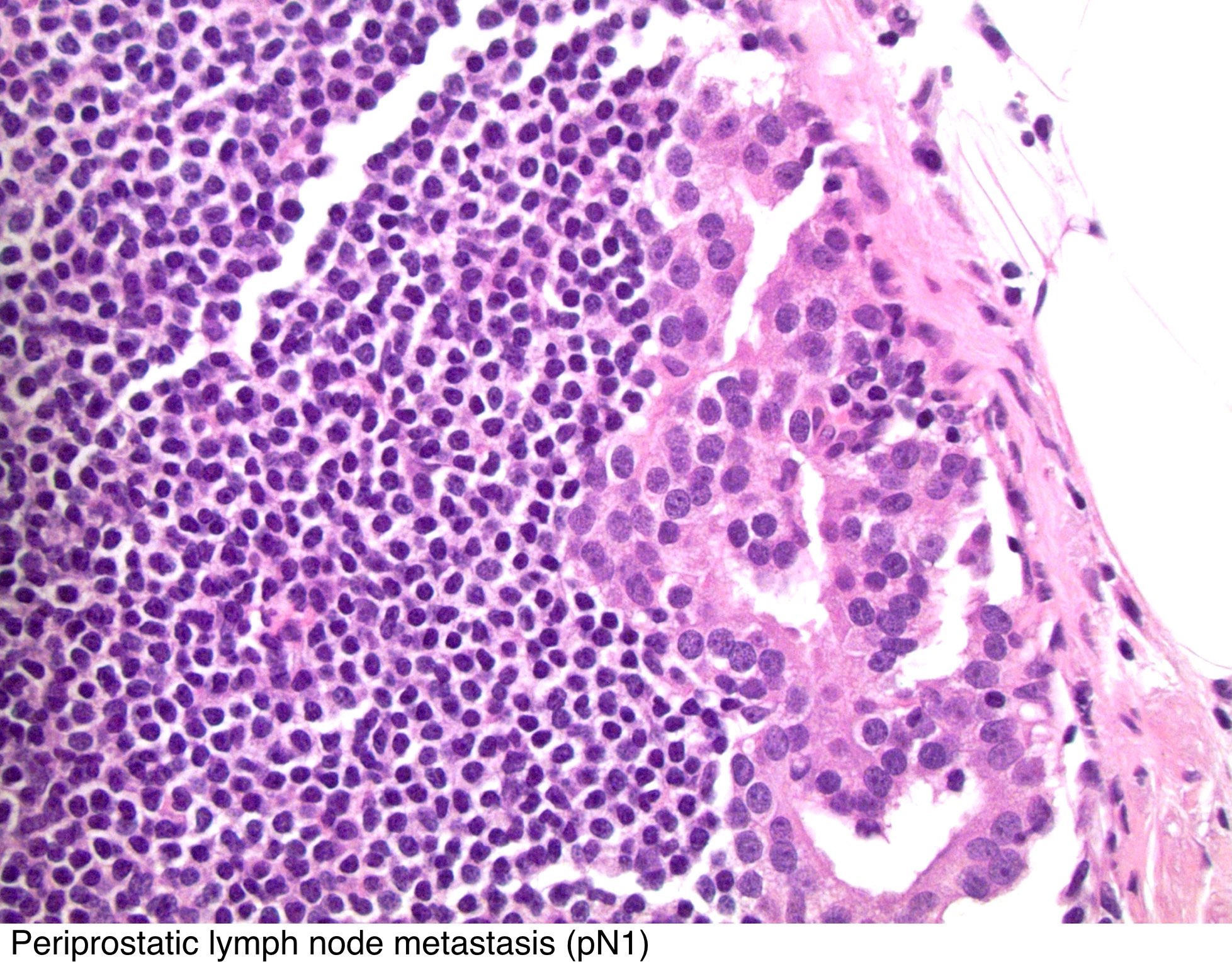prostate adenocarcinoma tnm pathology outlines