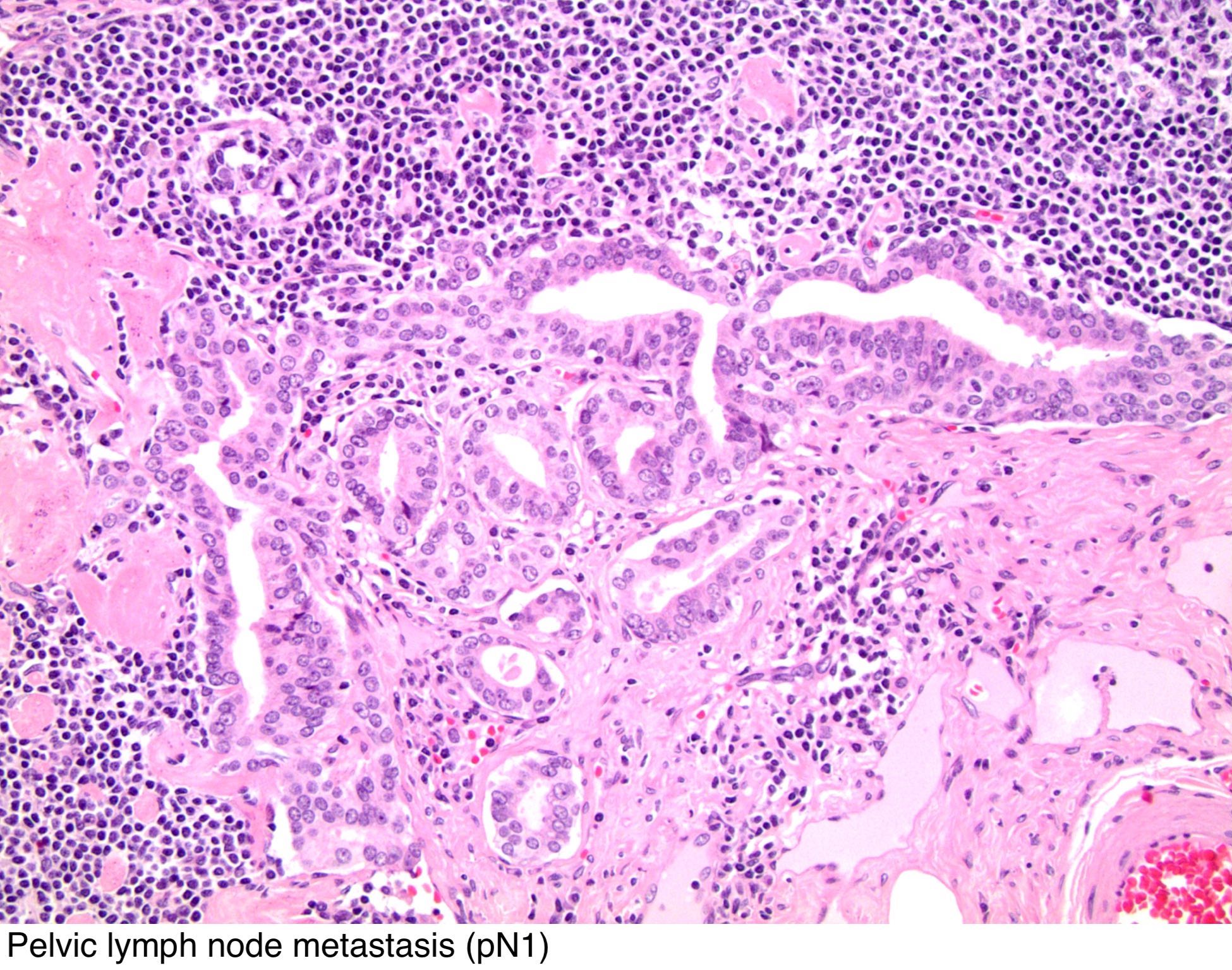 Urothelial cell papilloma, Inverted papilloma bladder pathology. Inverted urothelial papilloma