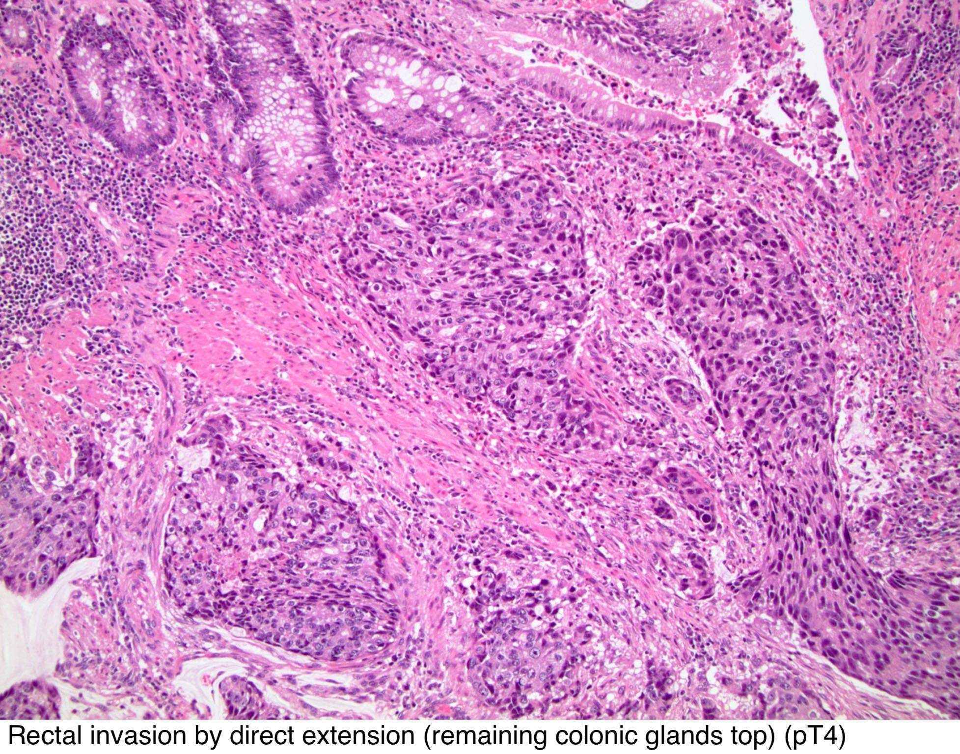 prostate adenocarcinoma tnm pathology outlines)