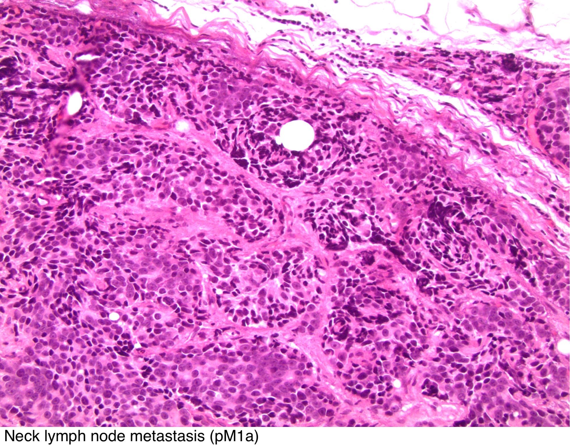 prostate tnm pathology outlines DGPZH krónikus számítási prosztatitis