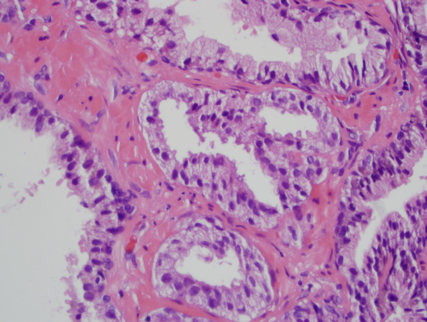 acinar adenocarcinoma of prostate pathology outlines)