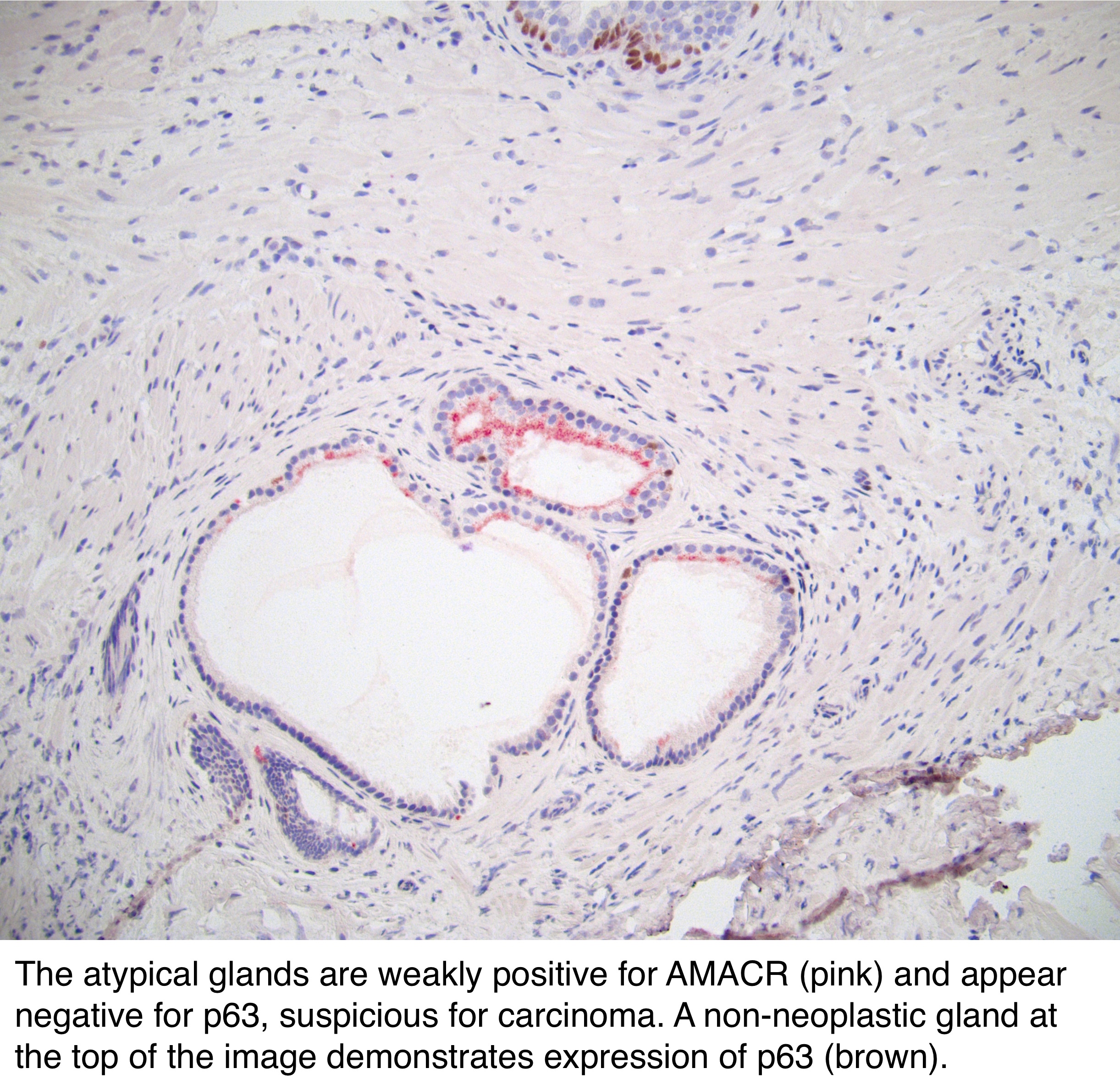 asap prostate pathology outlines psa 40 year old