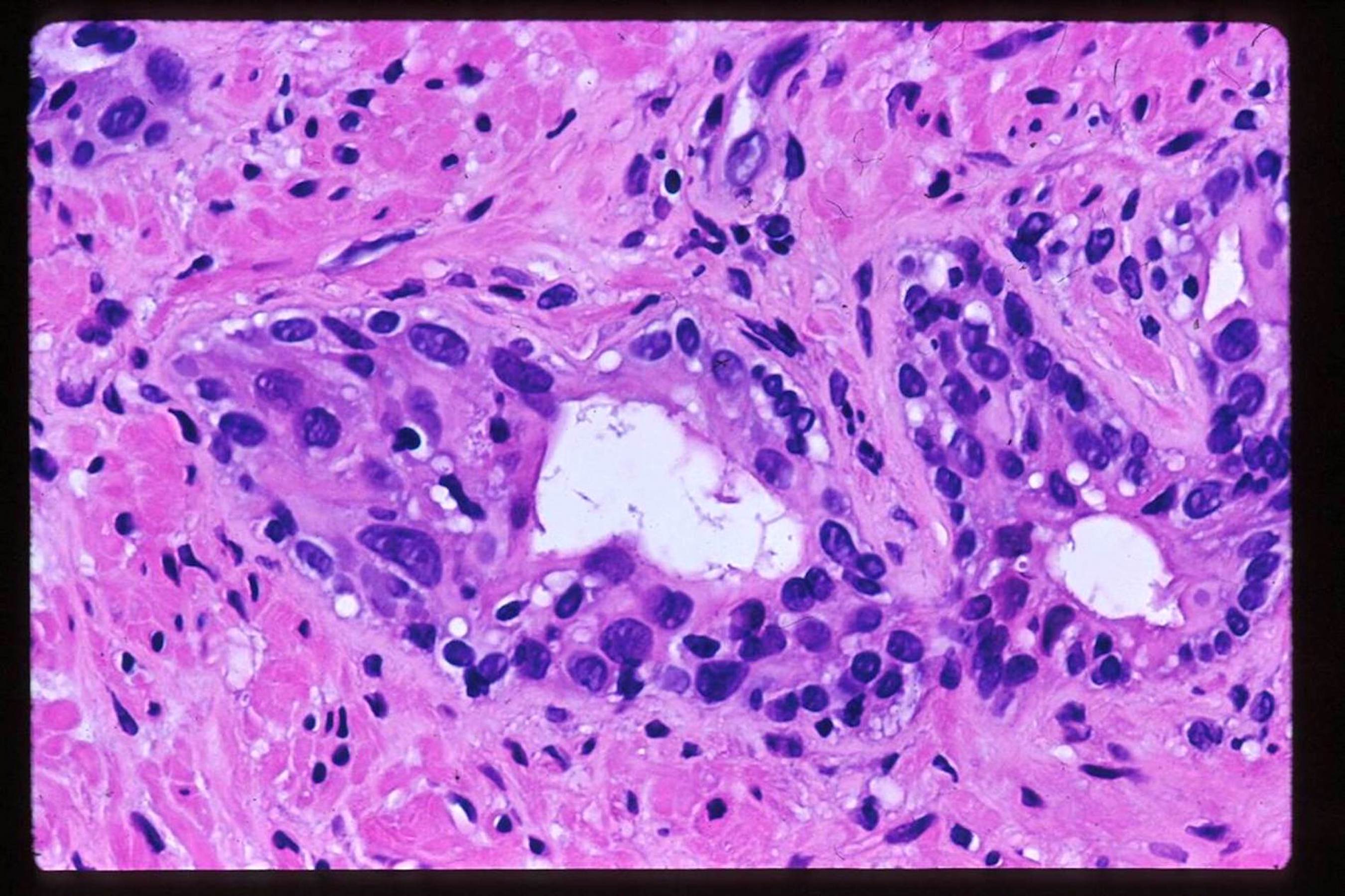 prostate cancer treatment effect histology