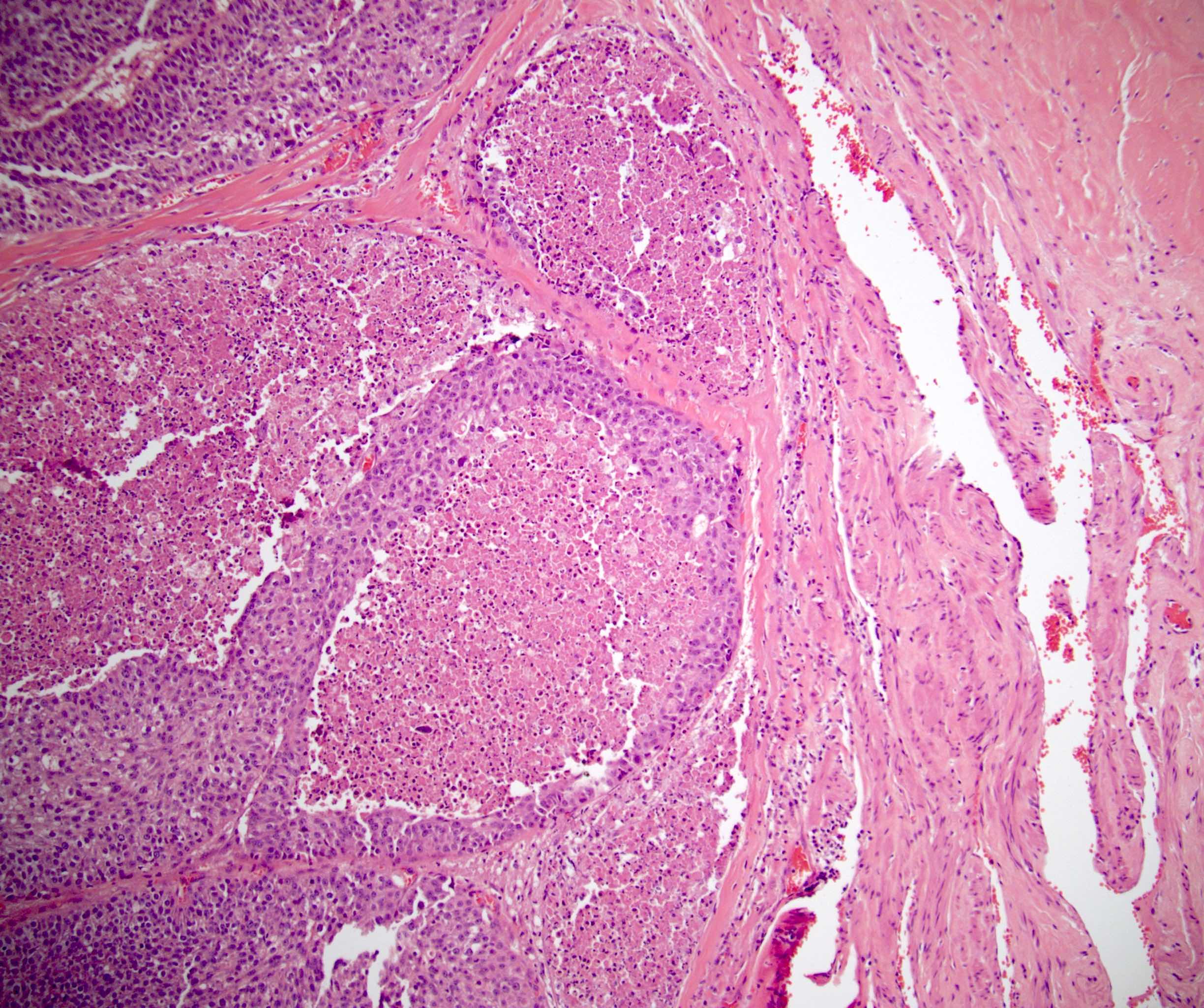 Penile urethral urothelial carcinoma (pT3)