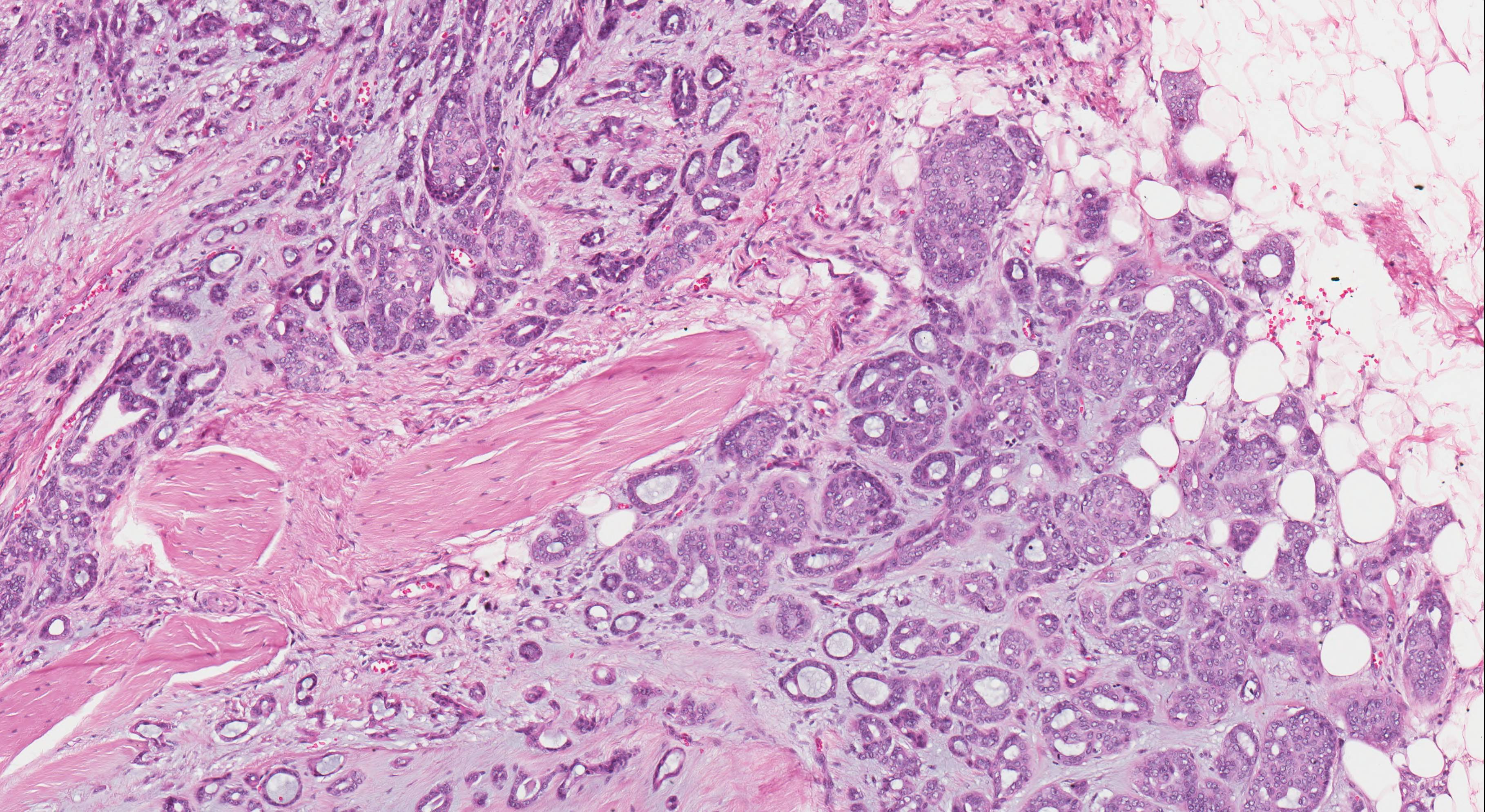 adenocarcinoma nos salivary gland pathology outlines)