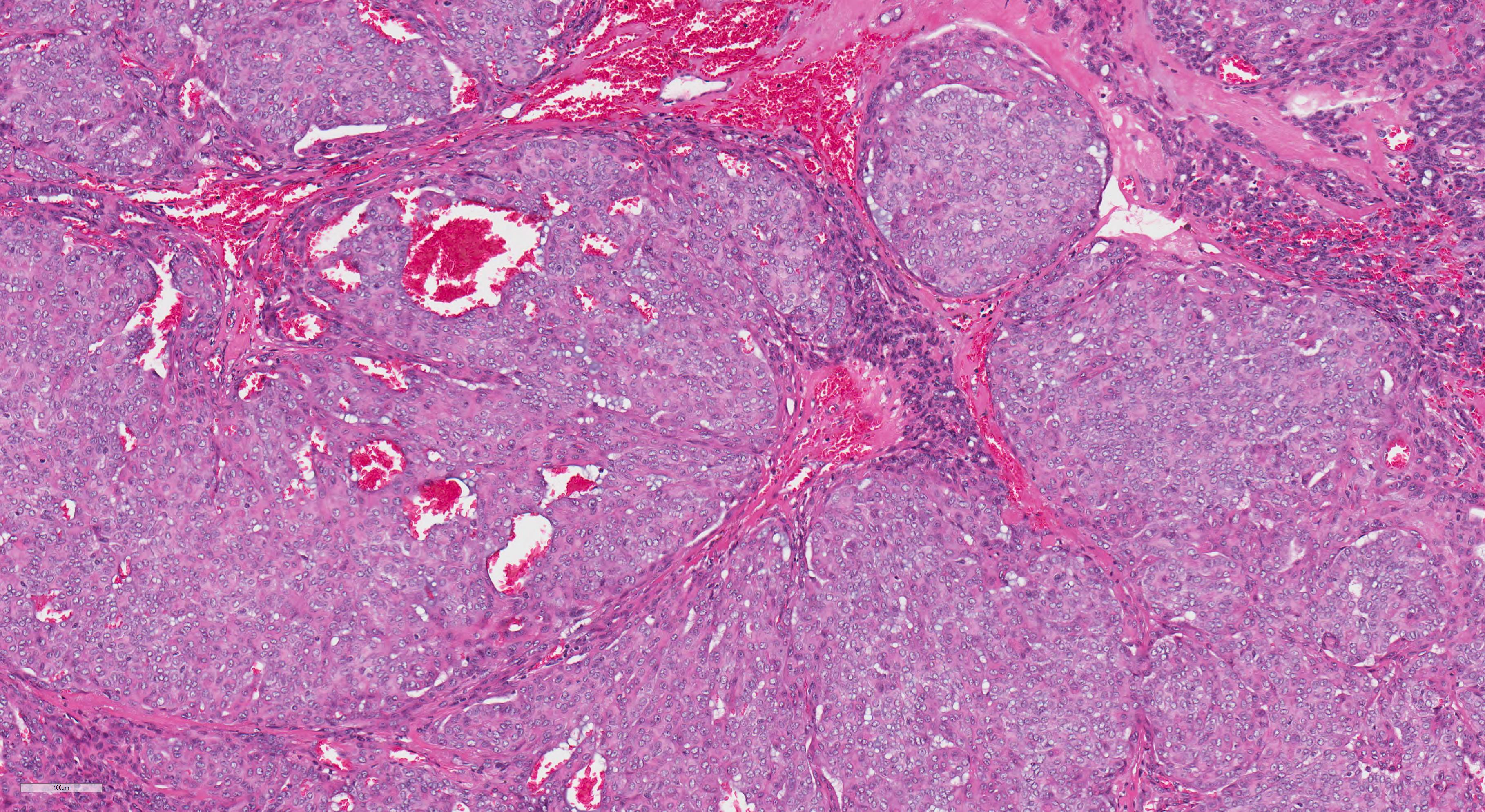 adenocarcinoma nos salivary gland pathology outlines