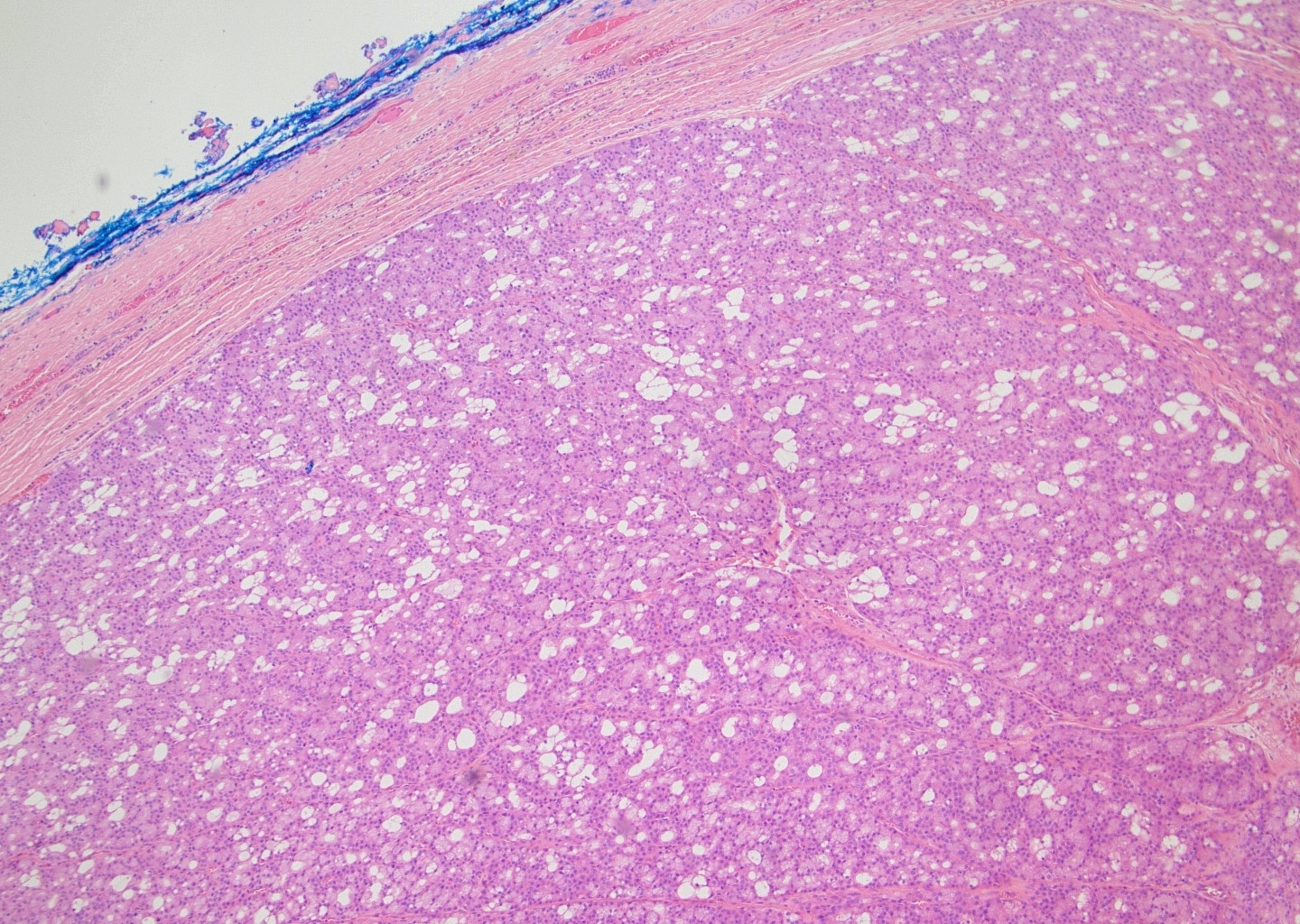 Well circumscribed tumor