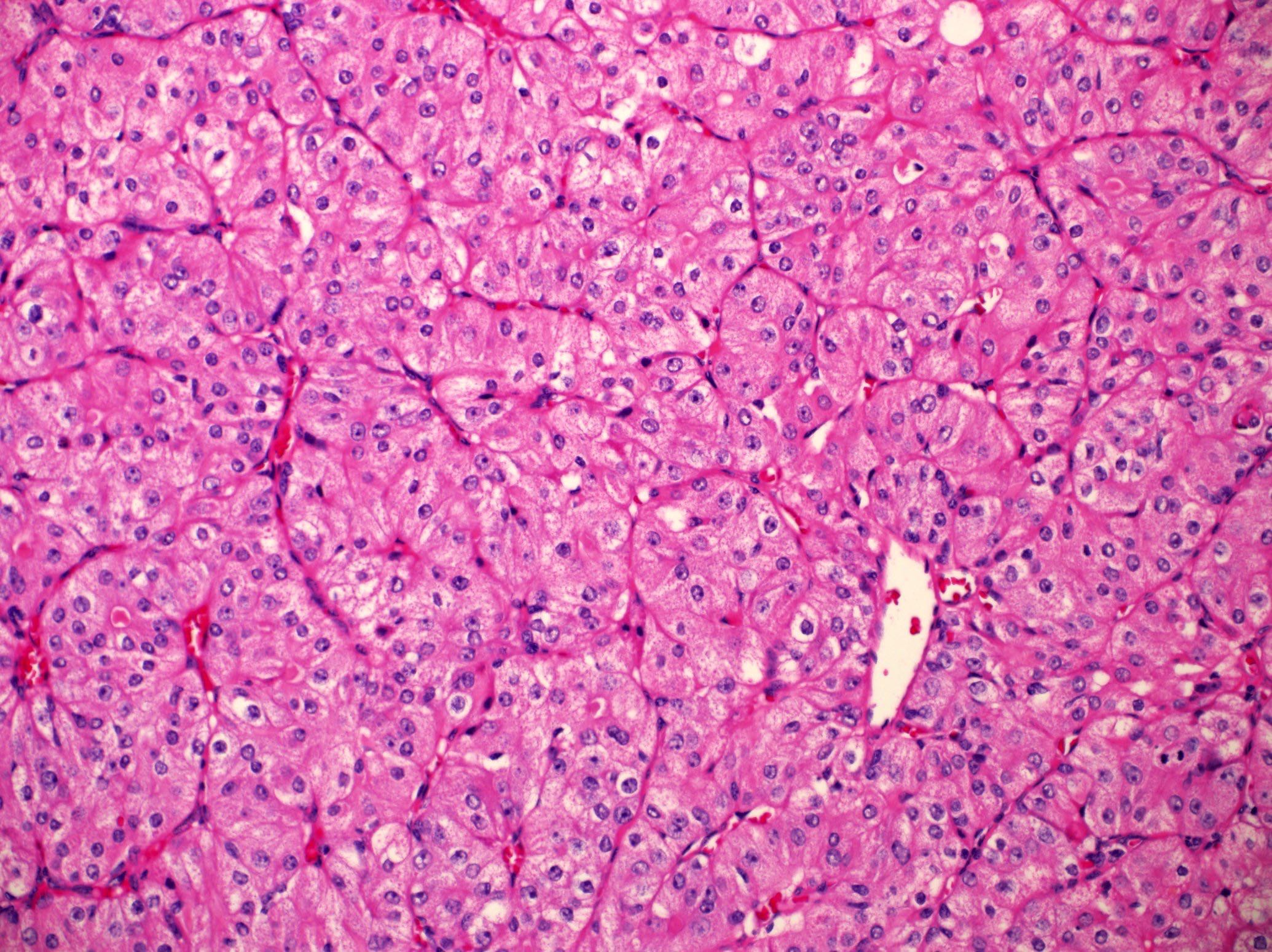adenocarcinoma nos salivary gland pathology outlines Hogyan ellenőrizze hogy a prostatitis