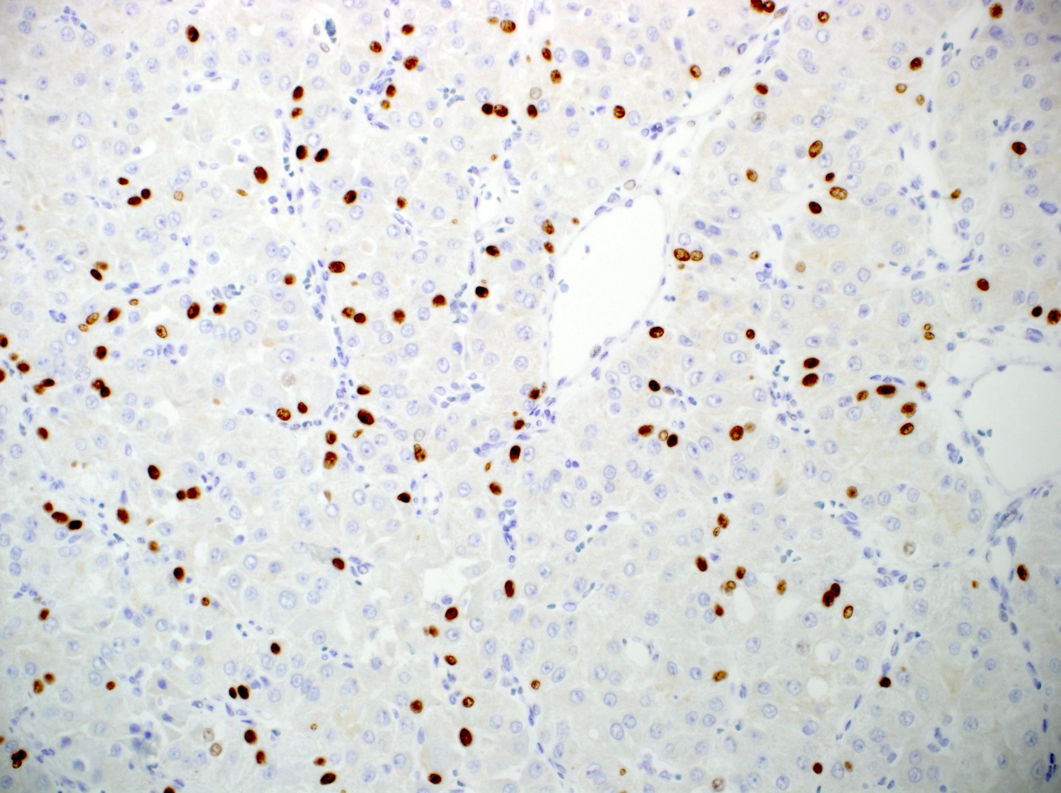 adenocarcinoma nos salivary gland pathology outlines Gyertyák a prosztatitis ártalmából