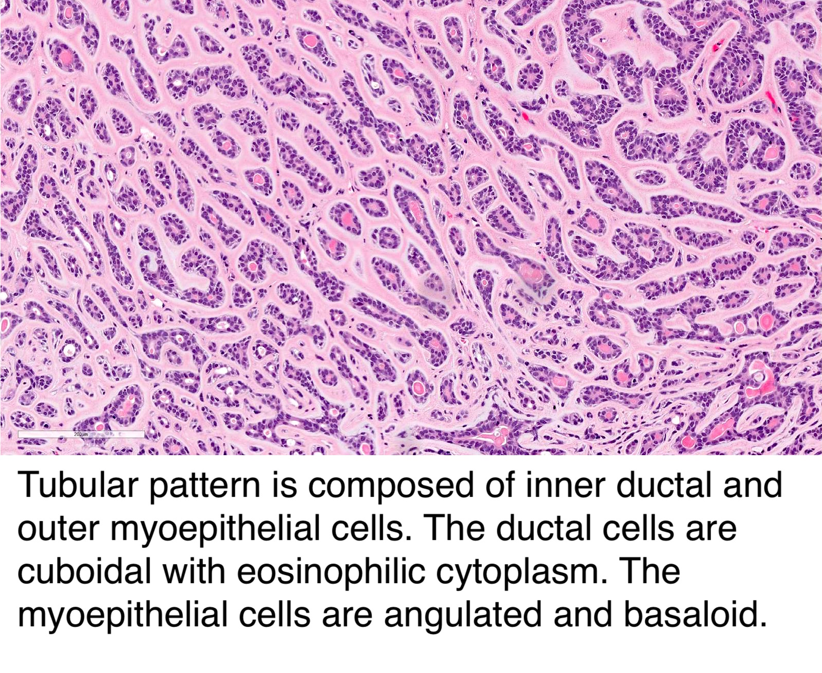 adenoid cystic carcinoma pathology