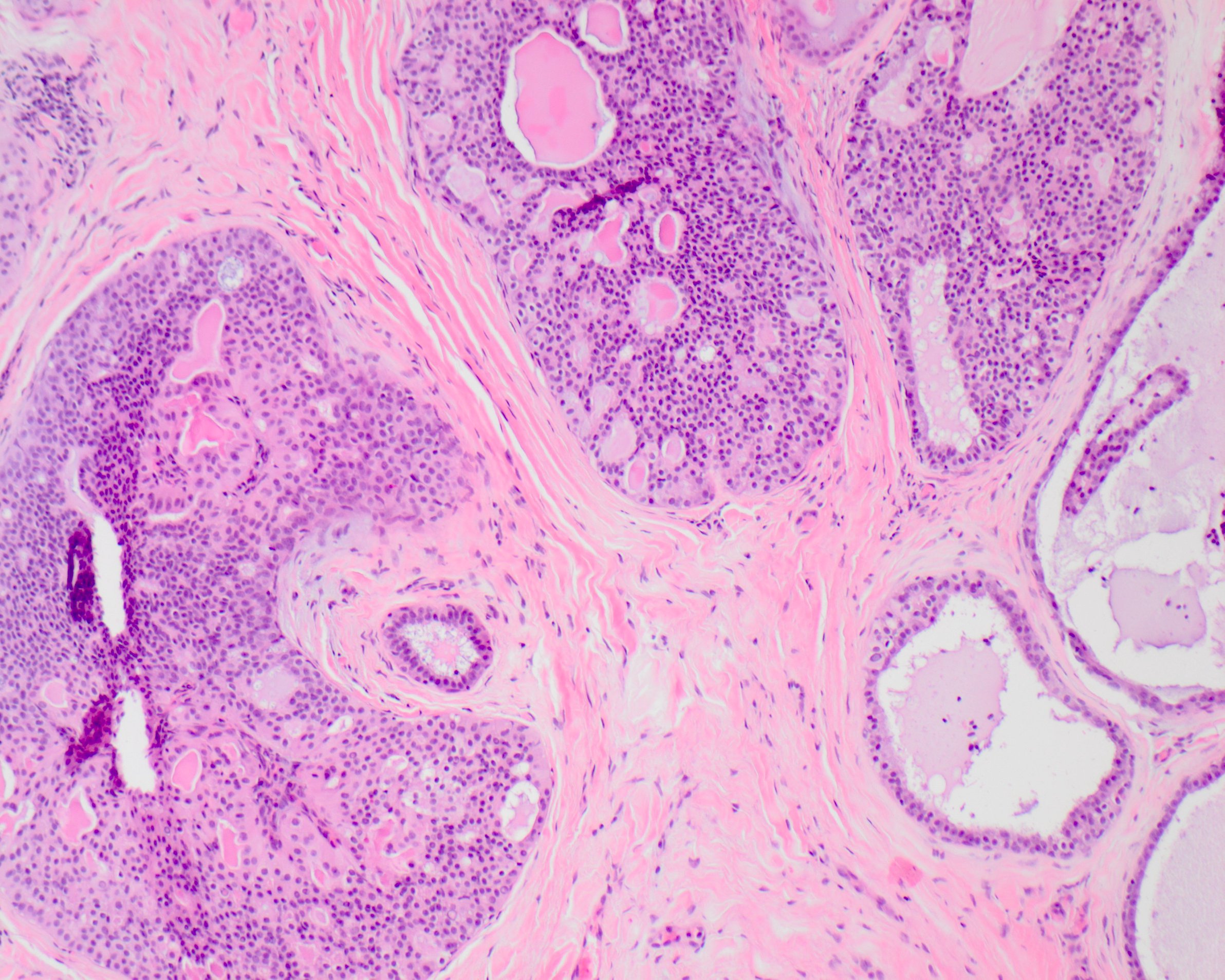 intraductal carcinoma prostate pathology outlines