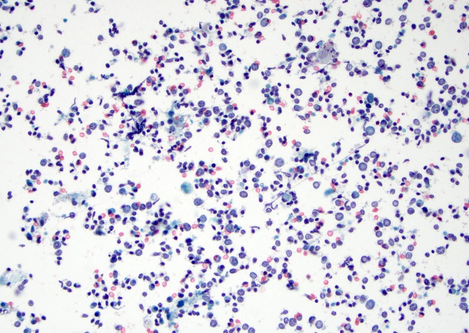 Polymorphous lymphocytes