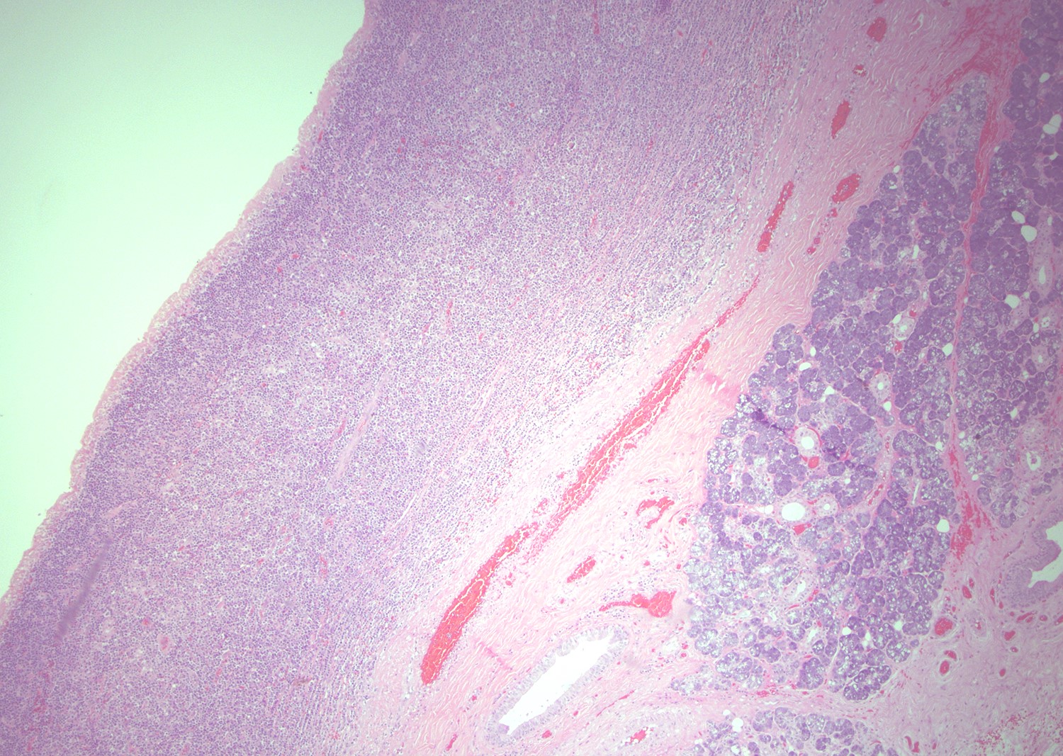Lymphoepithelial cyst high magnification