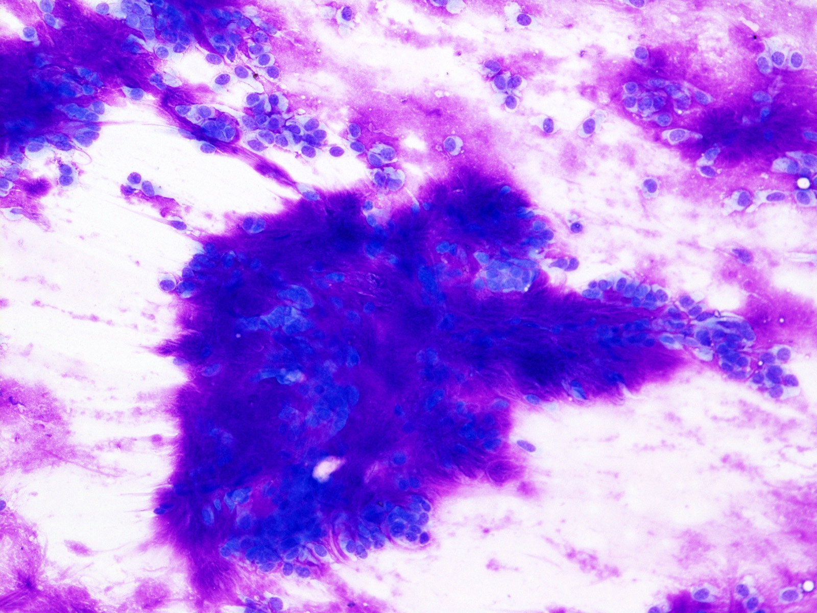 pleomorphic adenoma pathology outlines cytology Fű a prosztatitisből