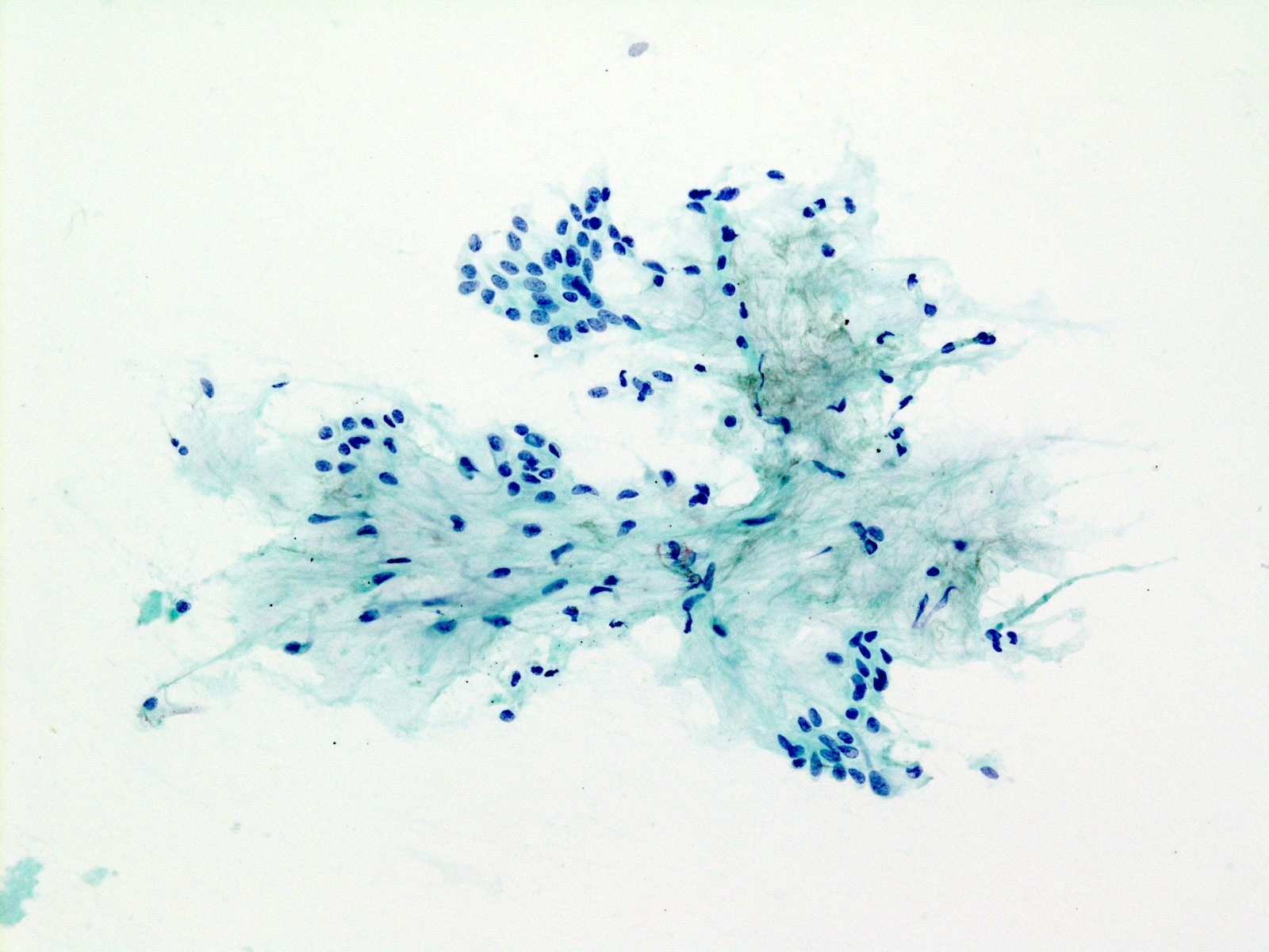 Pleomorphic adenoma (PA): fibrillary extracellular matrix