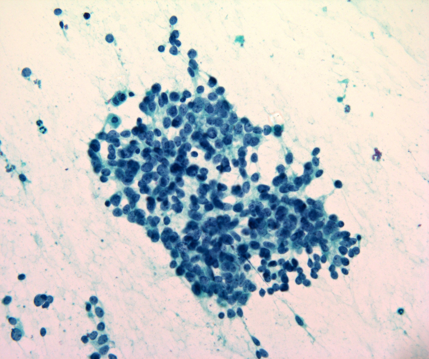 Suspicious for high grade basal cell adenocarcinoma