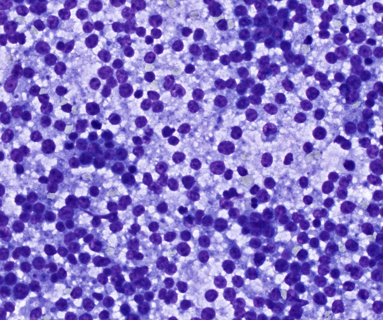 Suspicious for large cell lymphoma