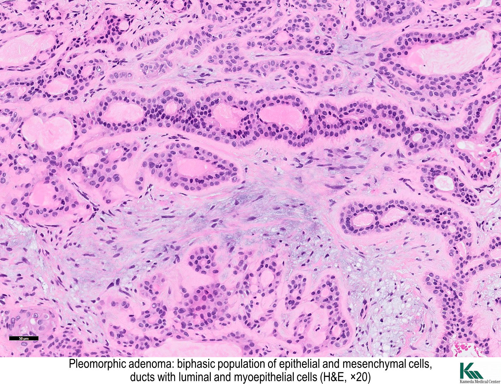 pleomorphic adenoma histology