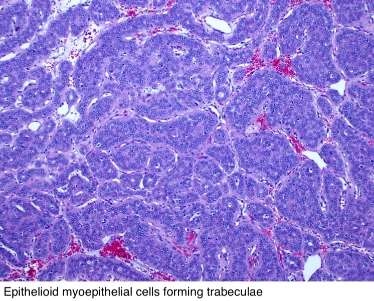 Pleomorphic adenoma parotid pathology outlines, Generate description