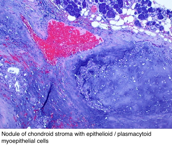 papilláris adenoma patológia körvonalai egy jó féregtabletta felnőtteknek