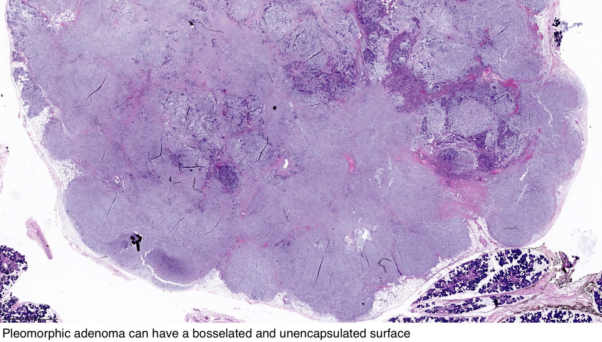 pleomorphic adenoma histology pathology outlines)