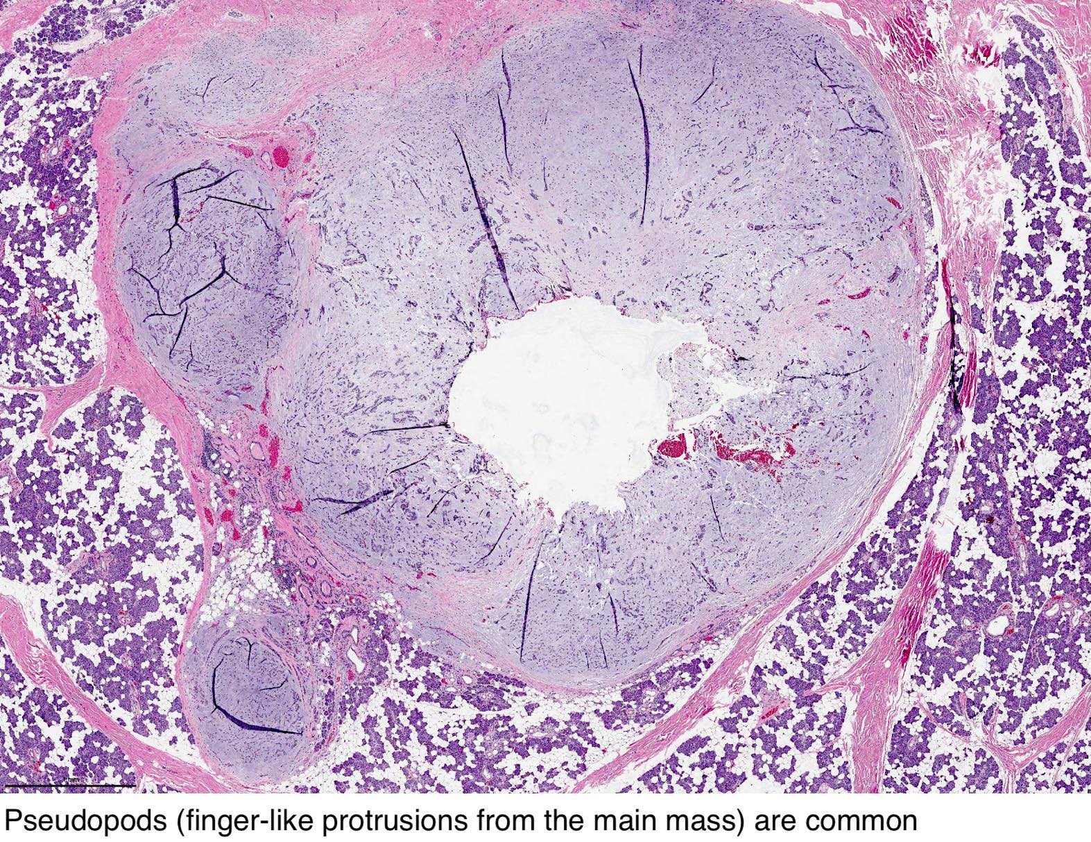 pleomorphic adenoma parotid pathology outlines)