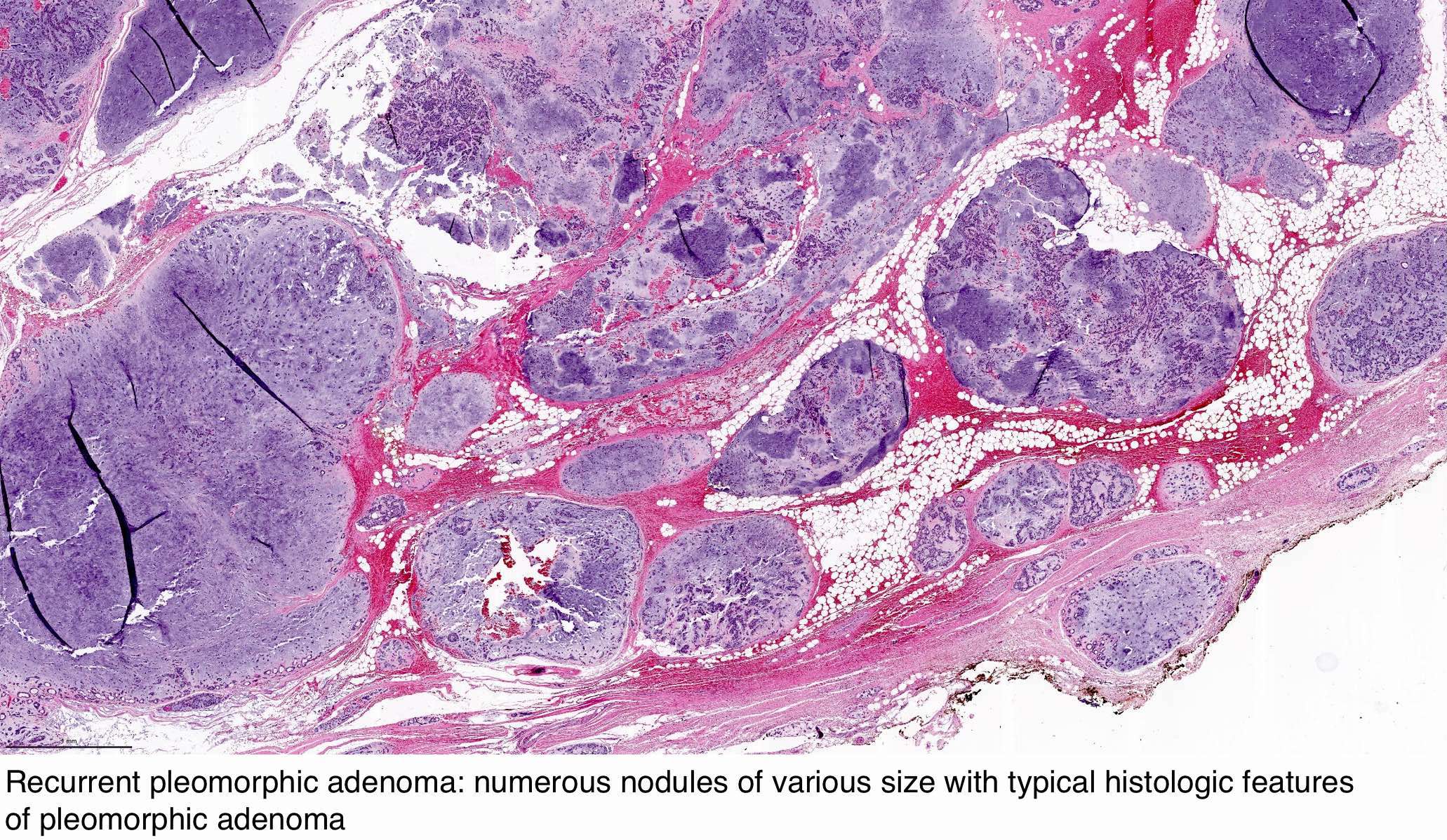 pleomorphic adenoma pathology outlines