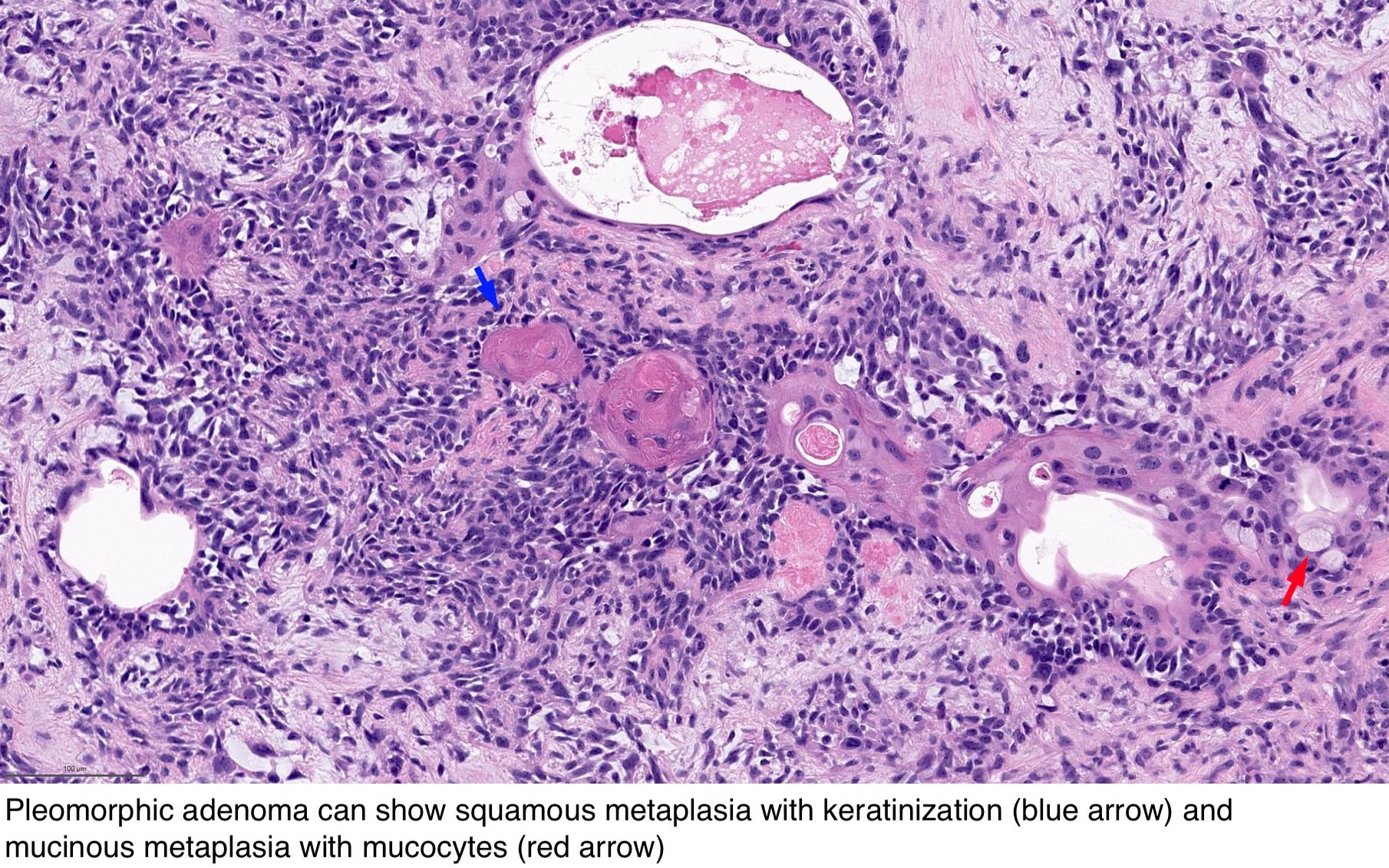 pleomorphic adenoma pathology outlines cytology Prostatitis tea recept