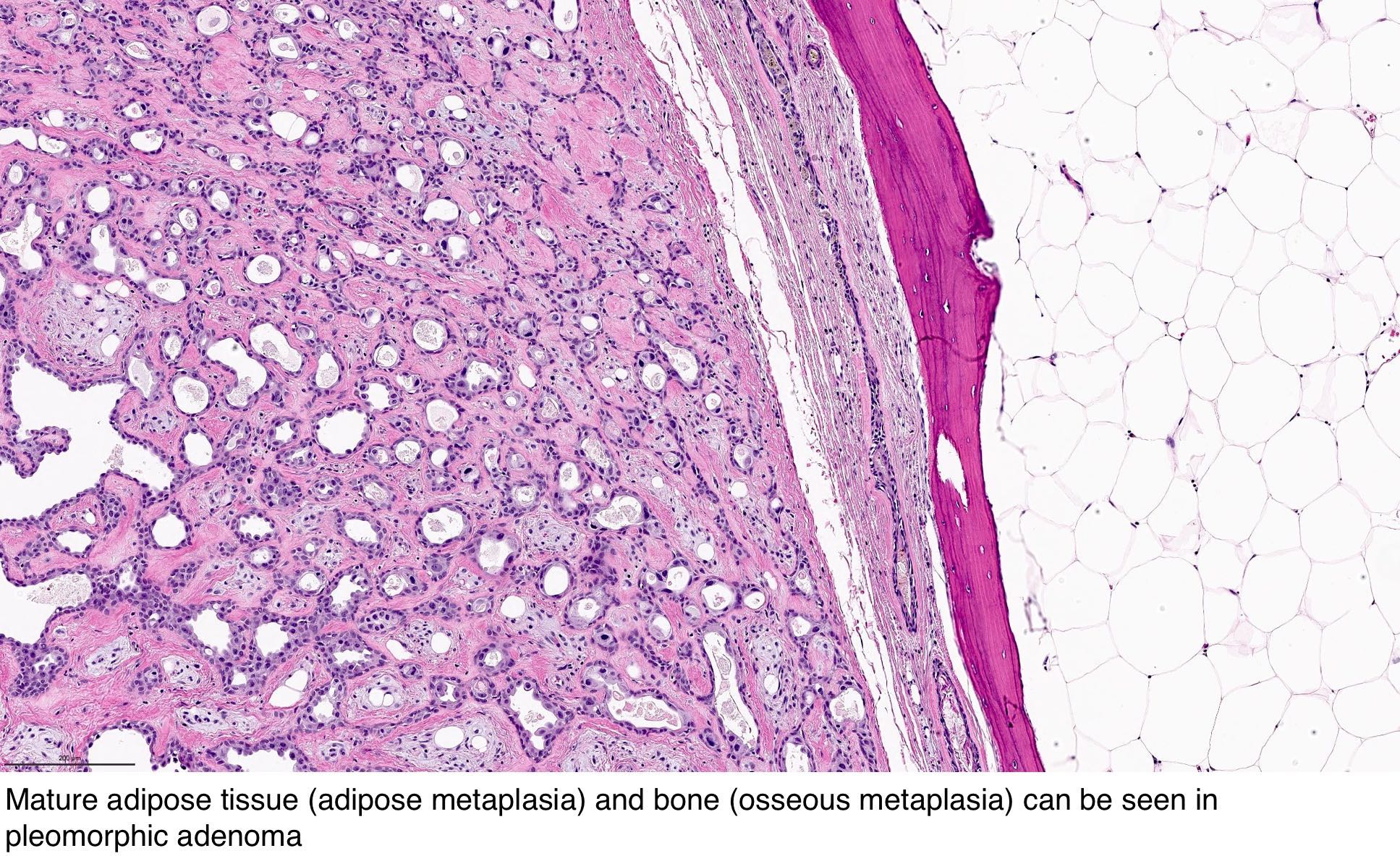 pleomorphic adenoma parotid pathology outlines