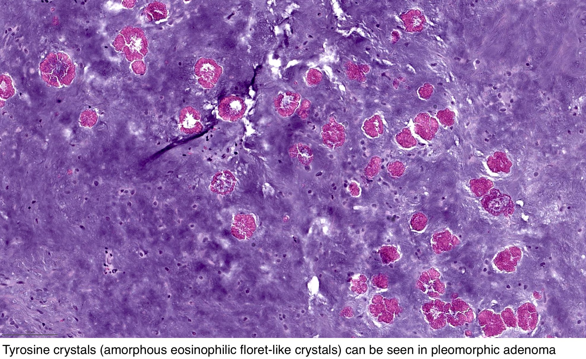 pleomorphic adenoma skin pathology outlines