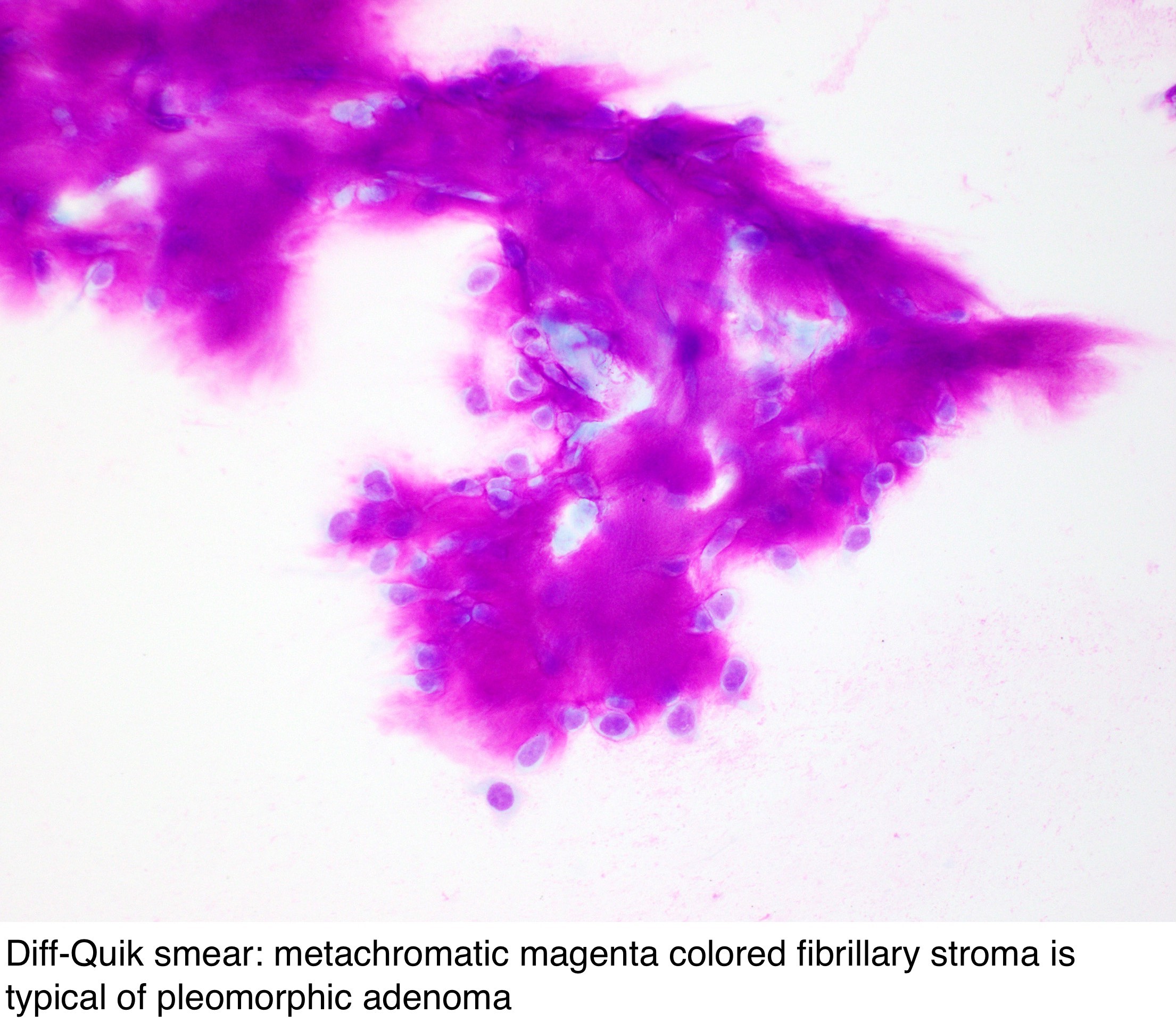pleomorphic adenoma pathology outlines cytology Prostate juice petrezselyem